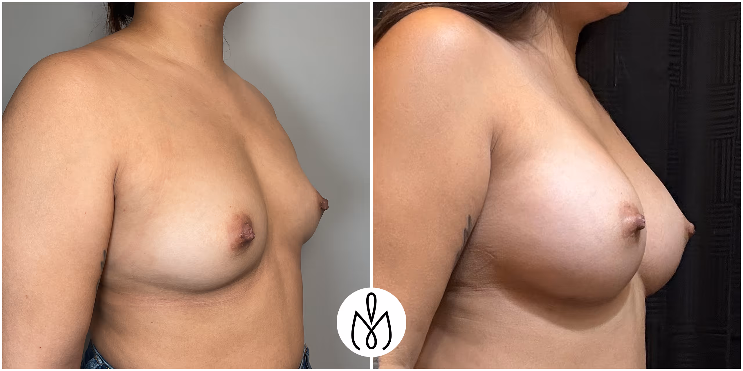 Before,After