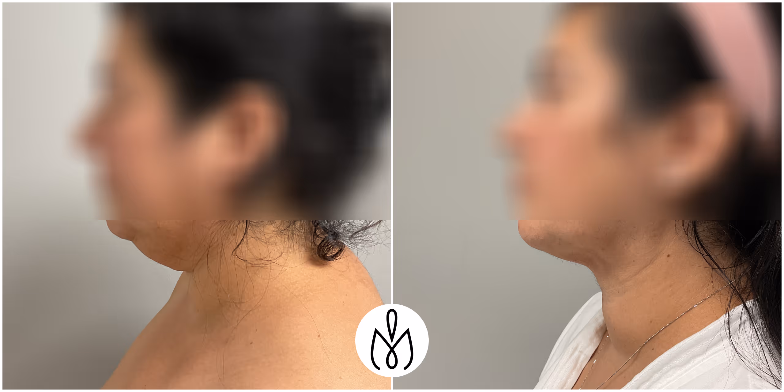 Before,After