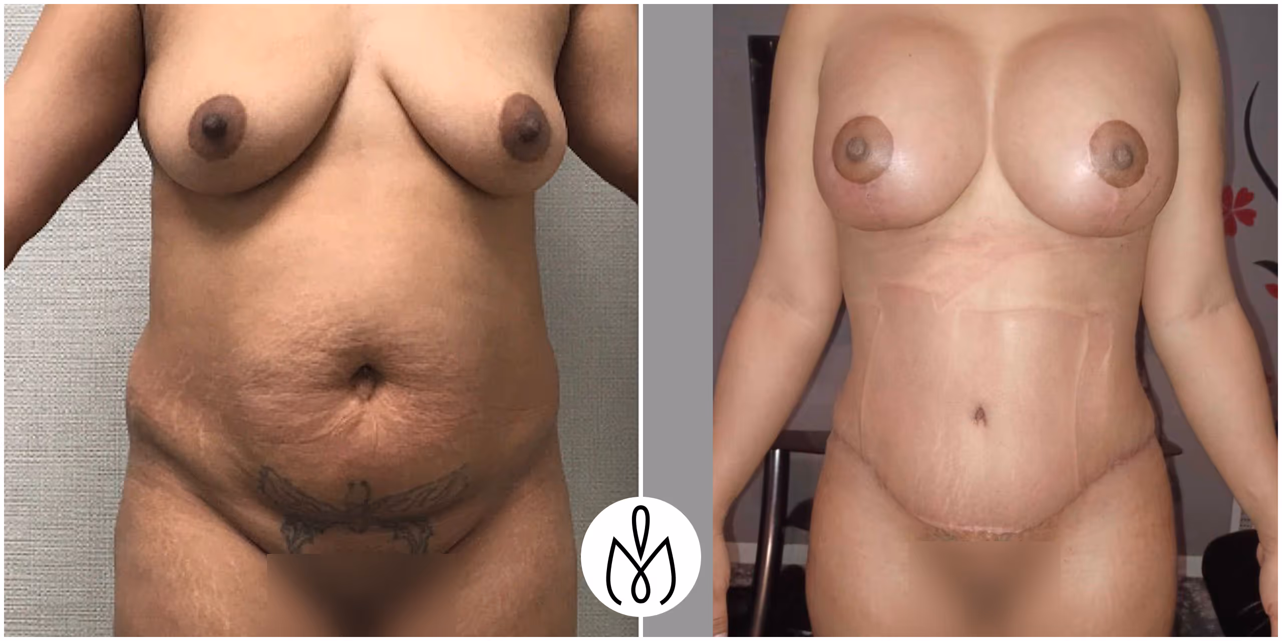 Before,After