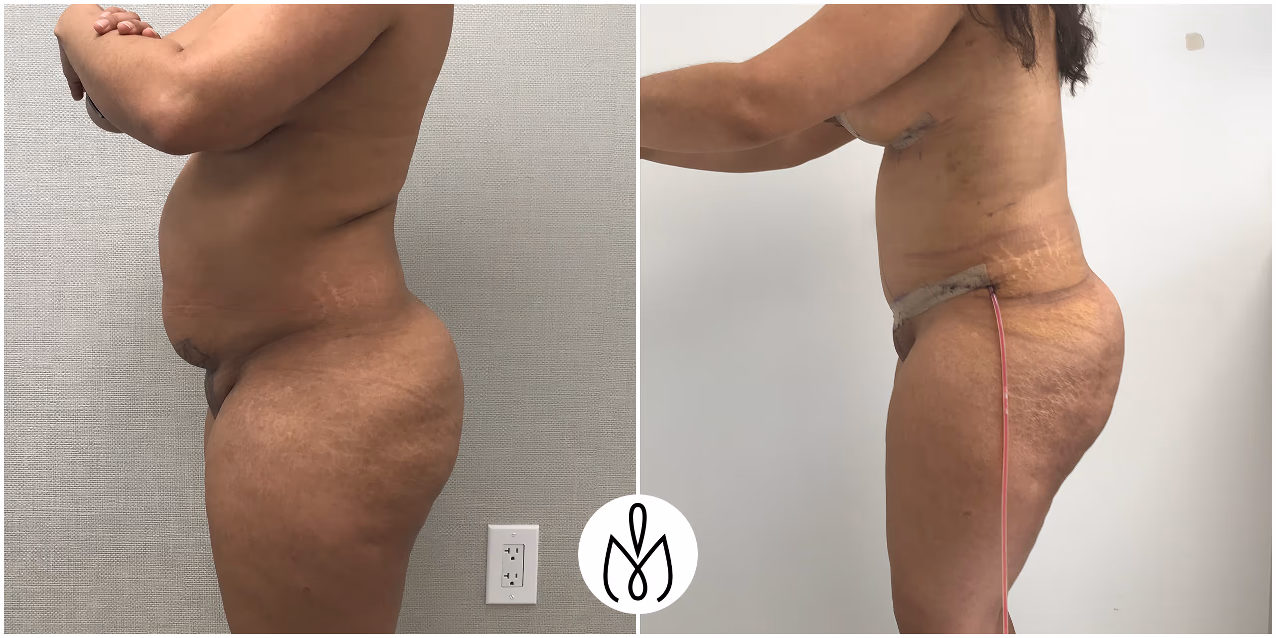 Before,After