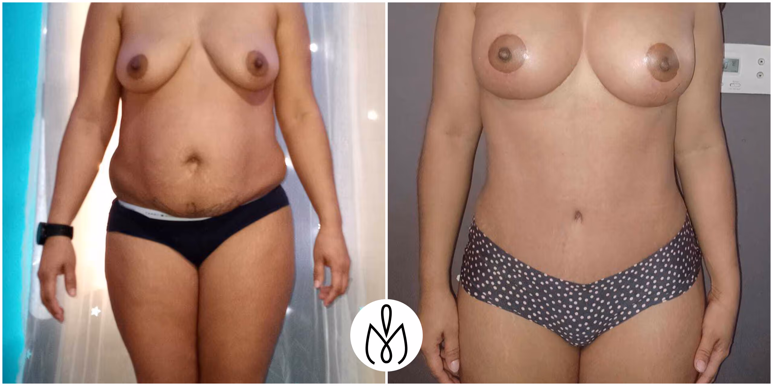 Before,After