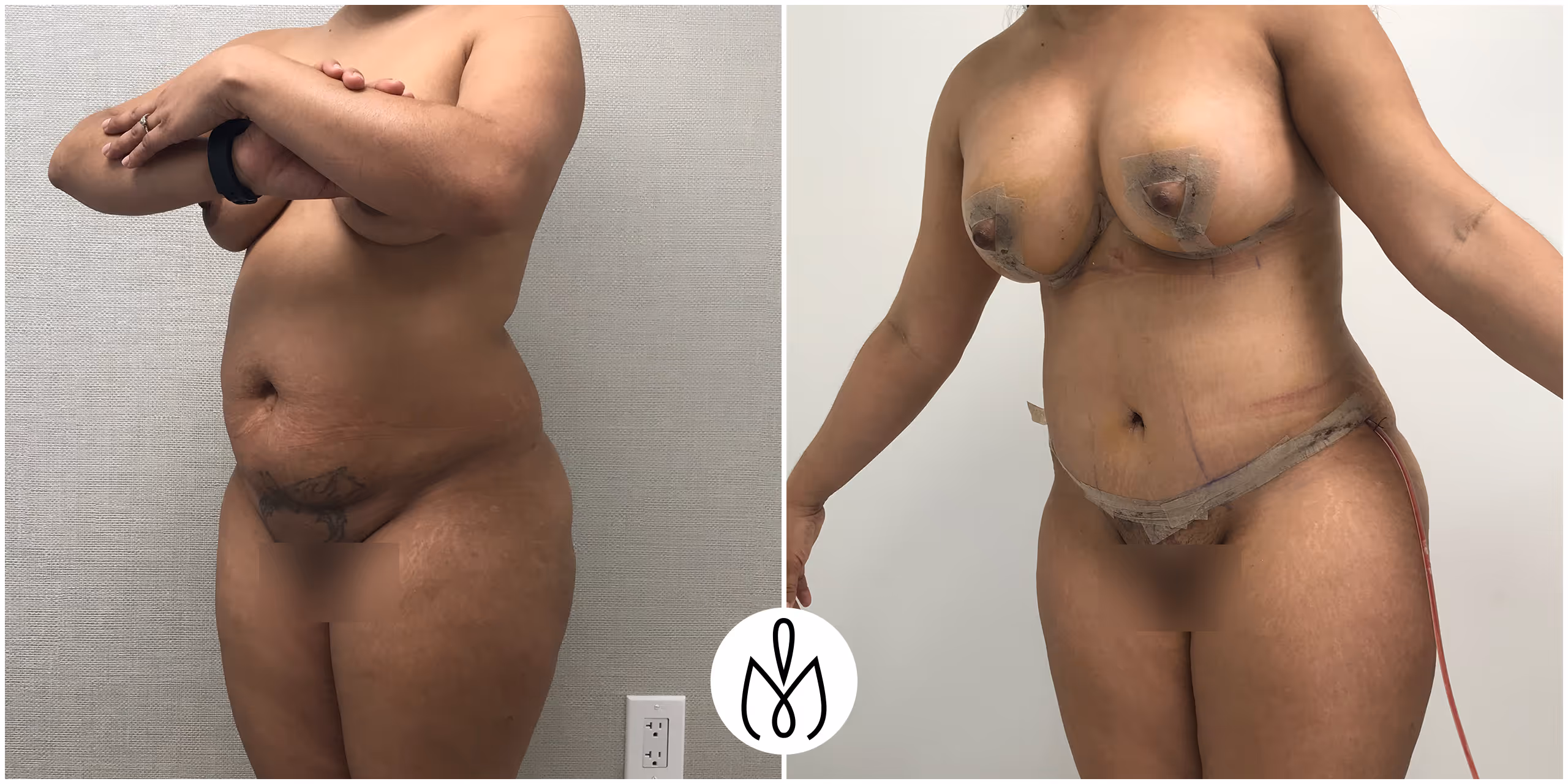 Before,After
