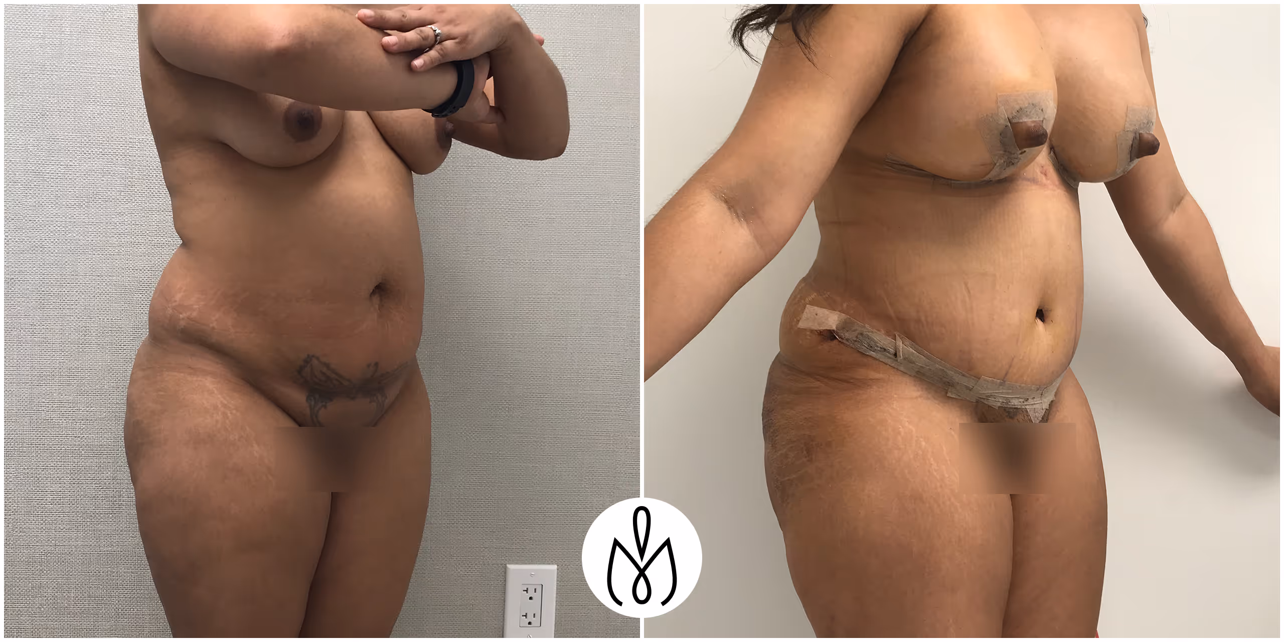 Before,After