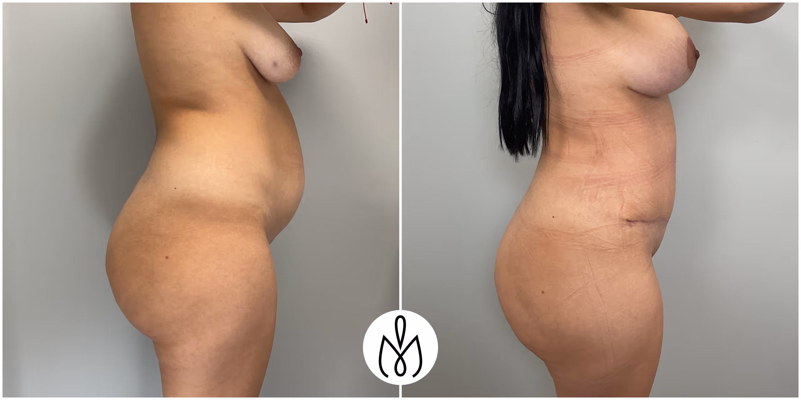 Before,After