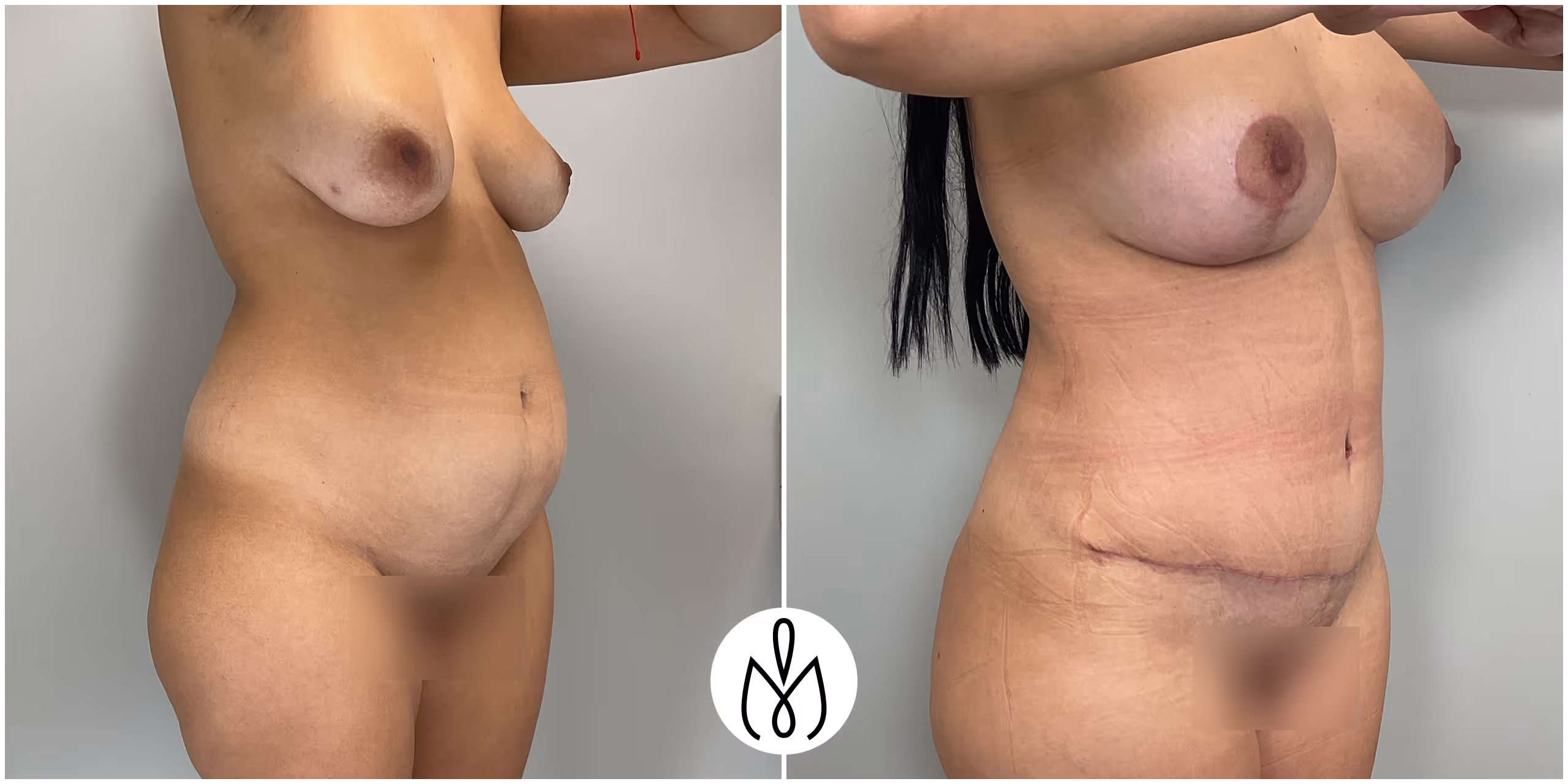 Before,After