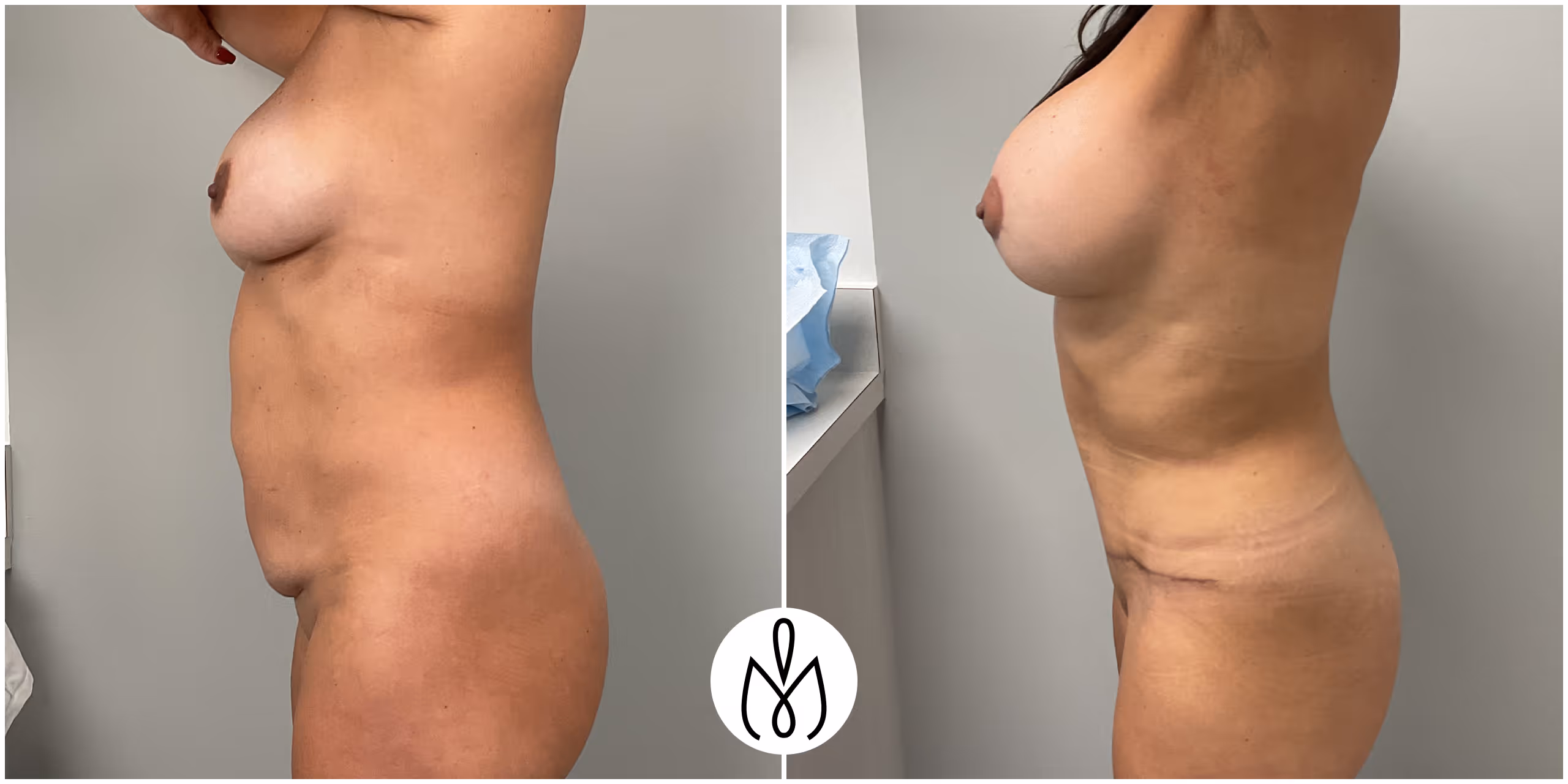 Before,After