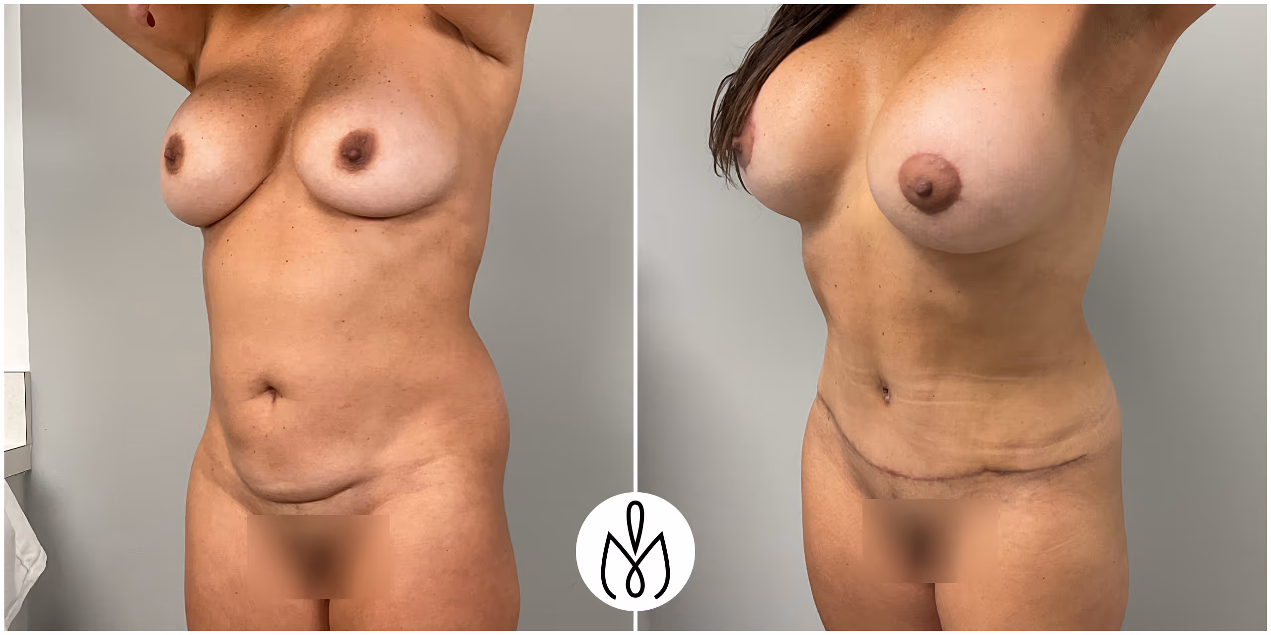 Before,After