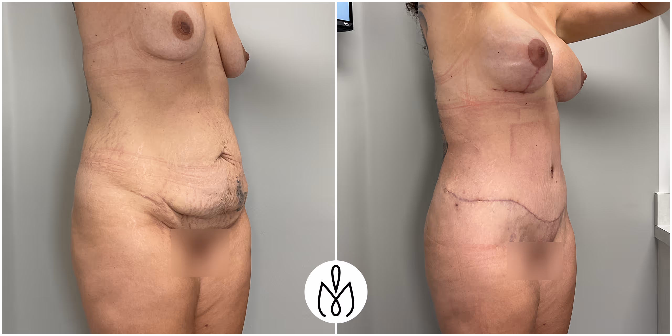 Before,After