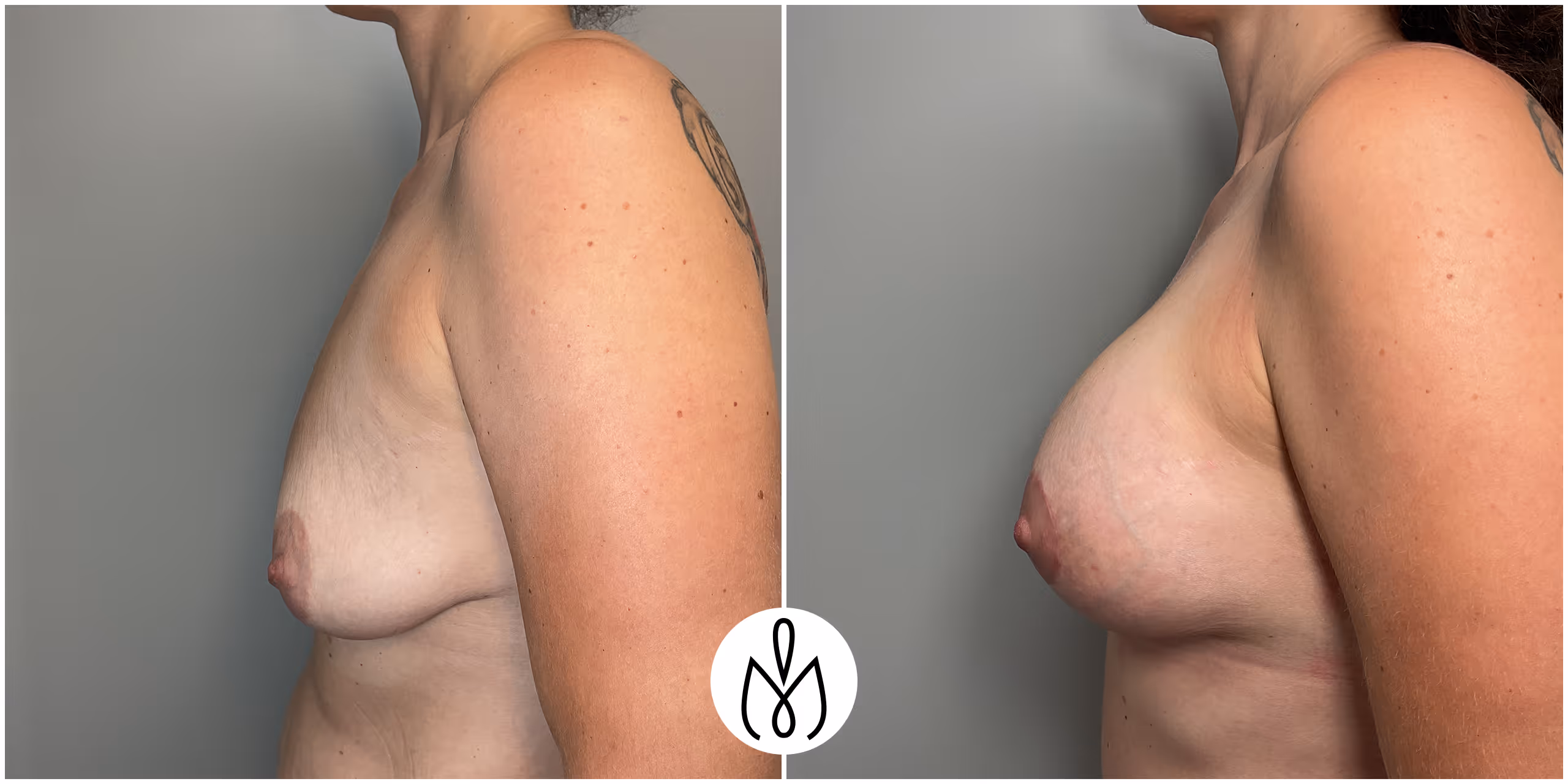Before,After