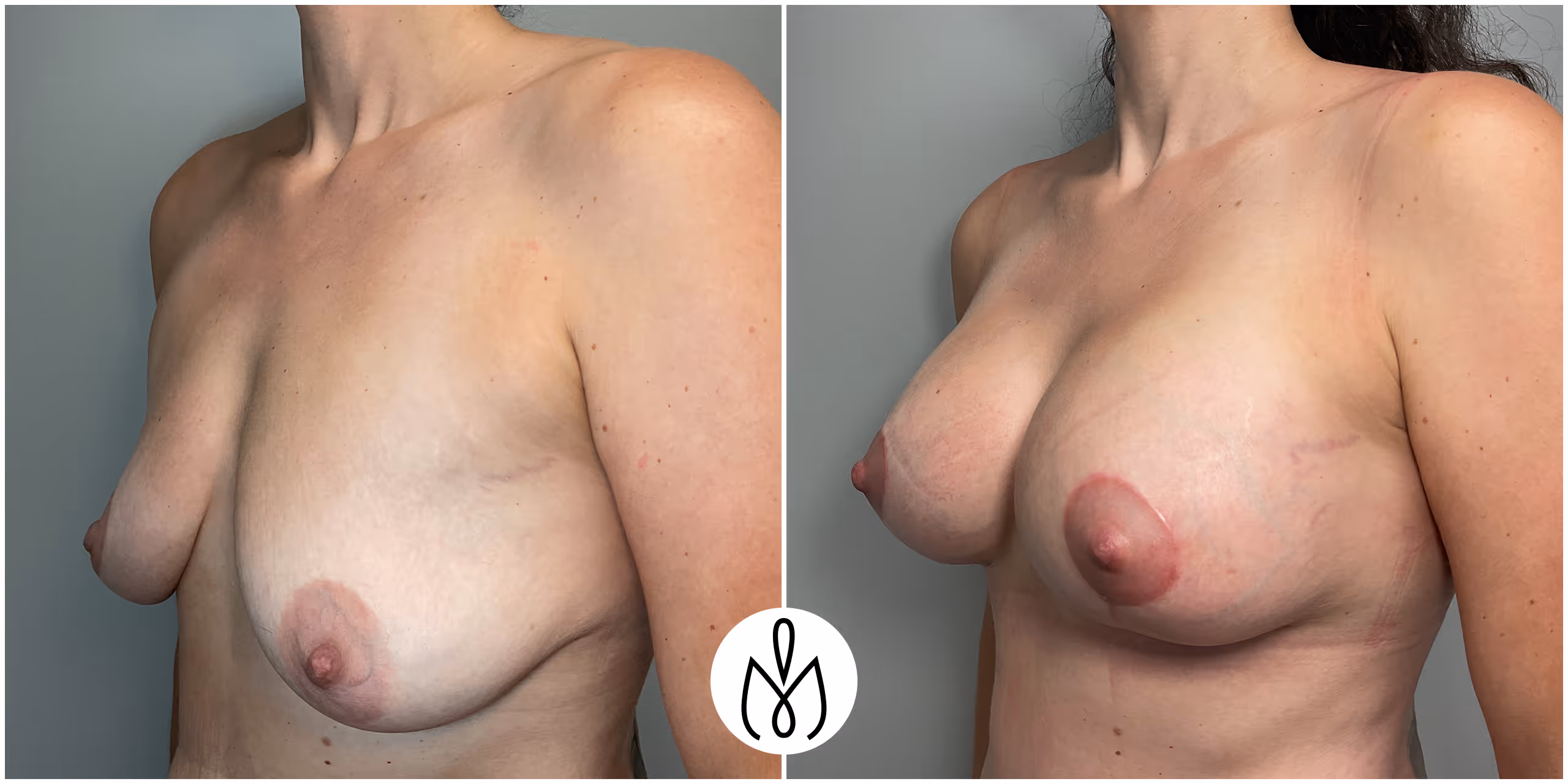 Before,After