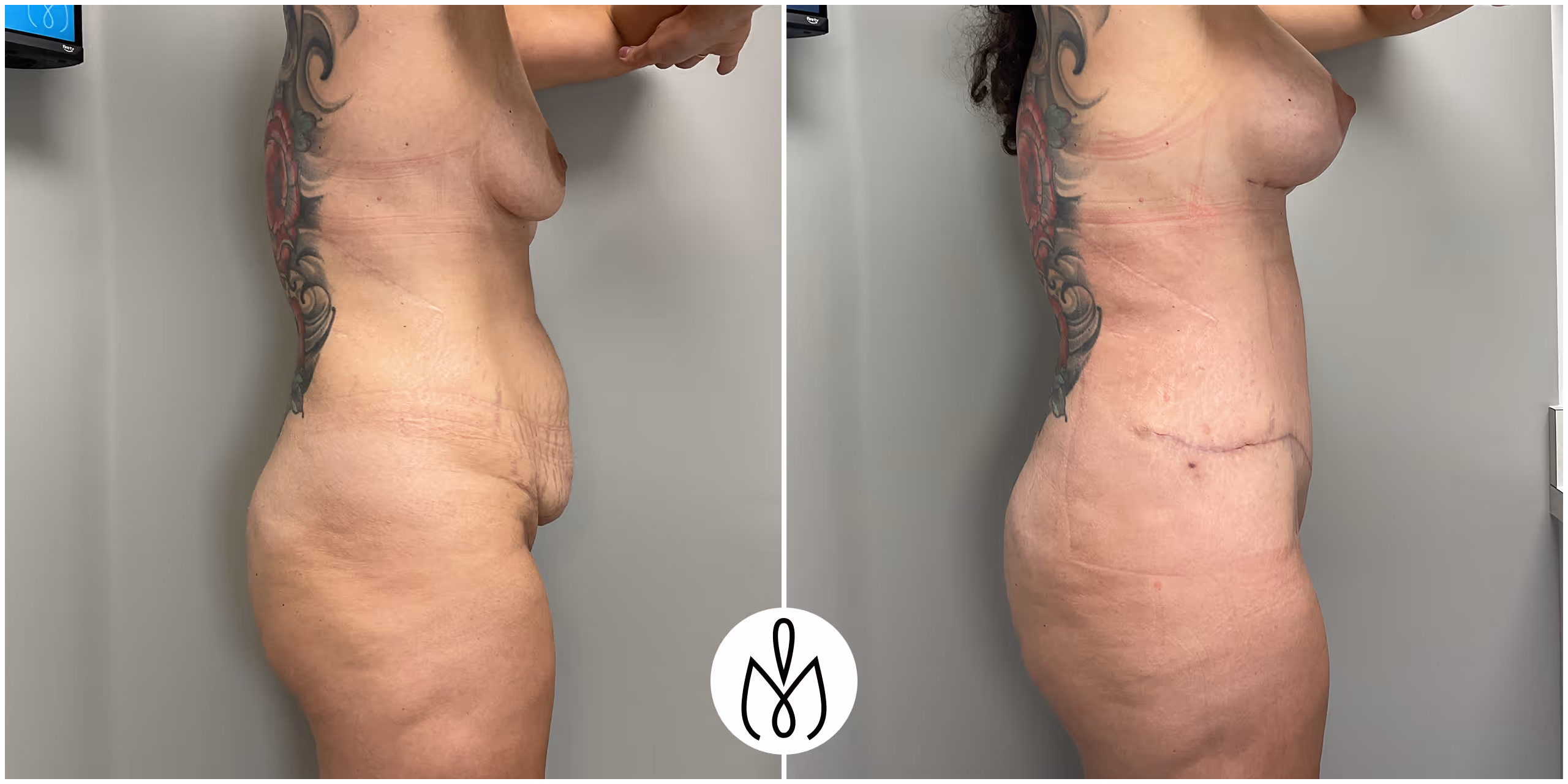 Before,After