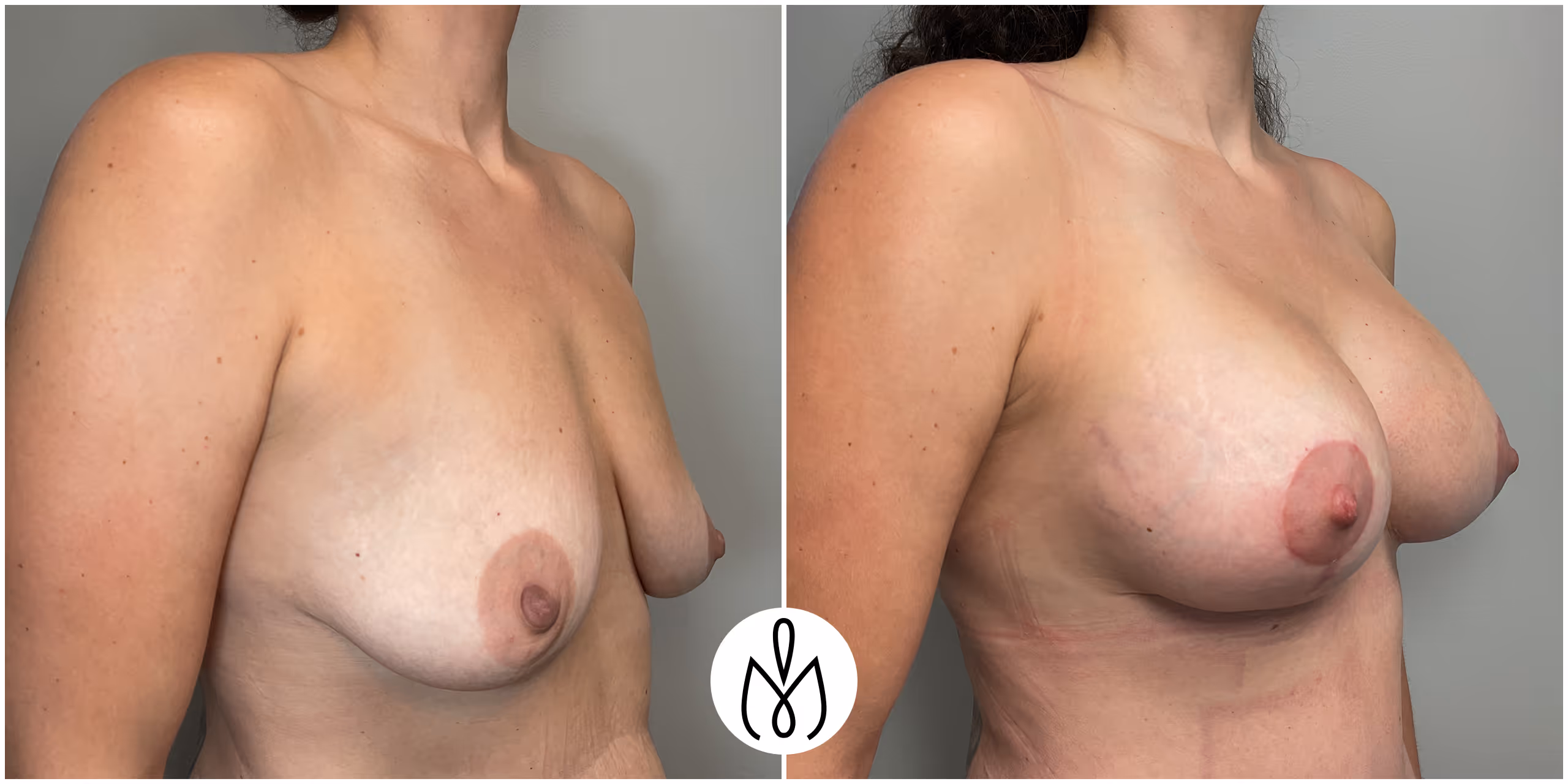 Before,After