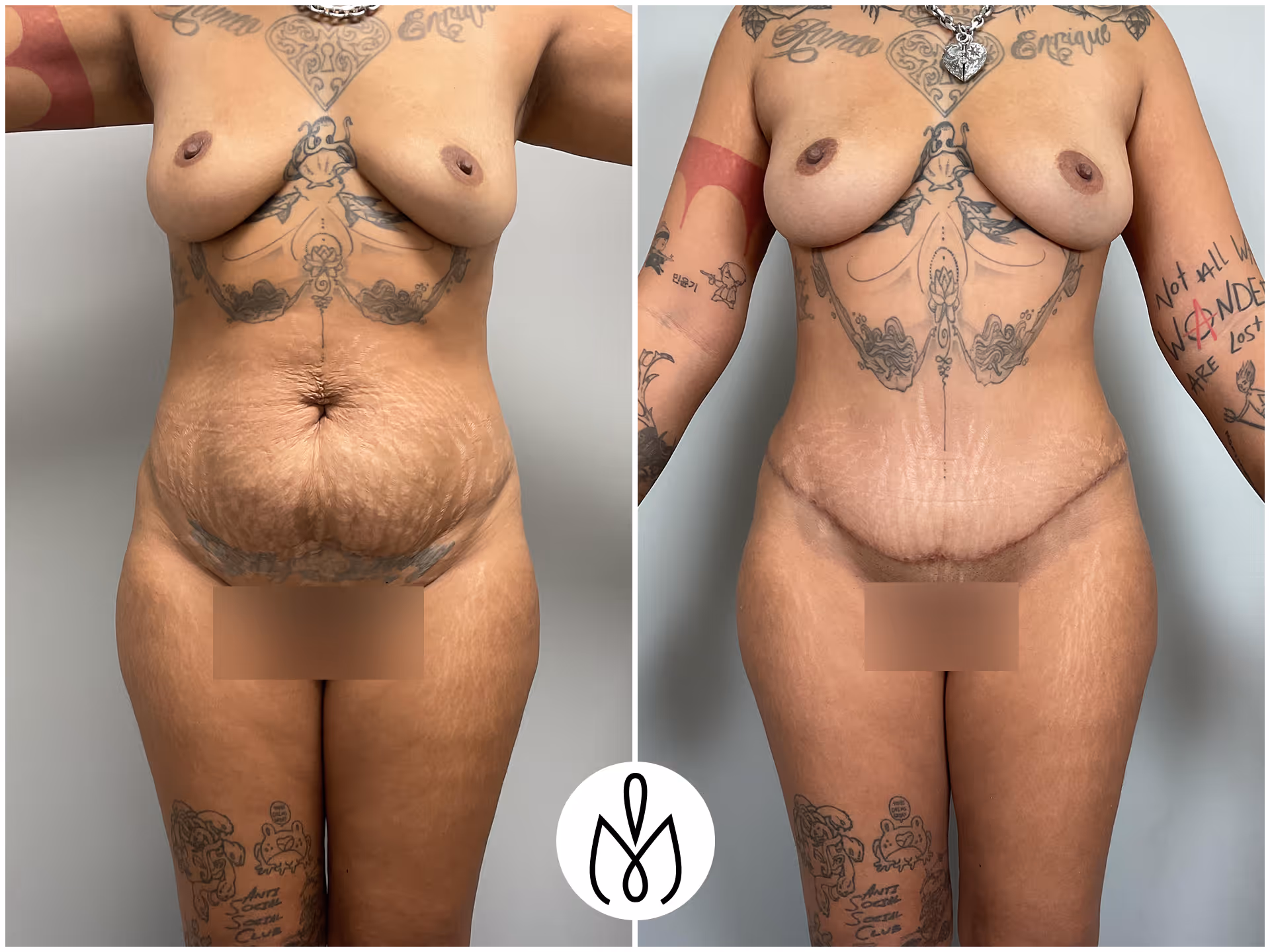 Before,After