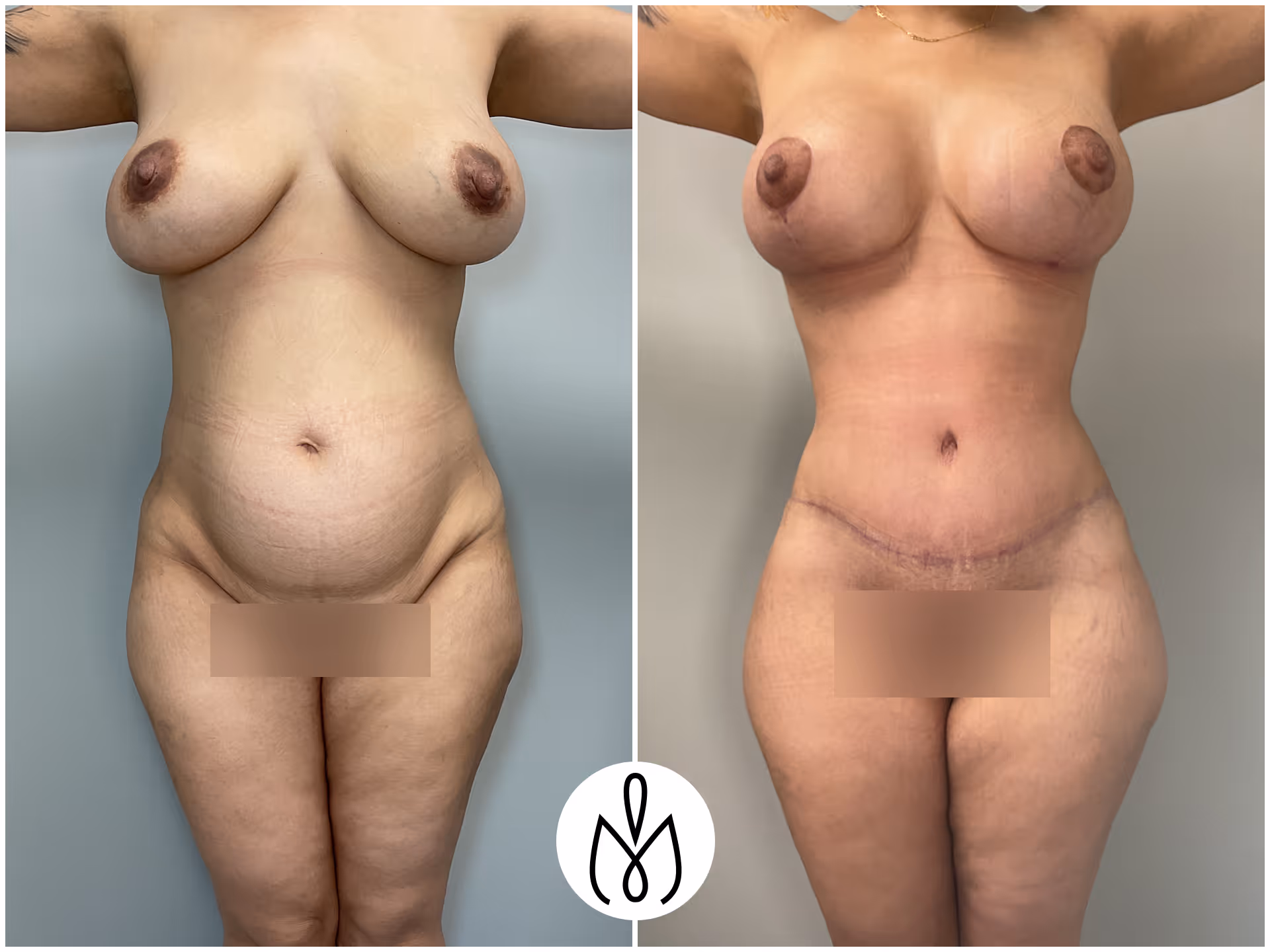 Before,After