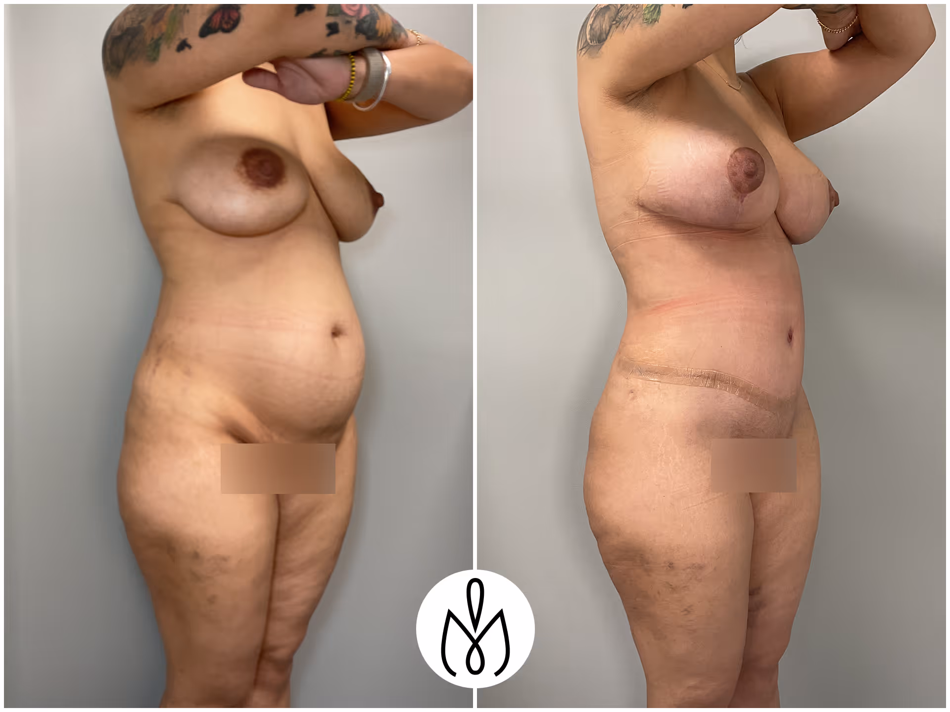 Before,After