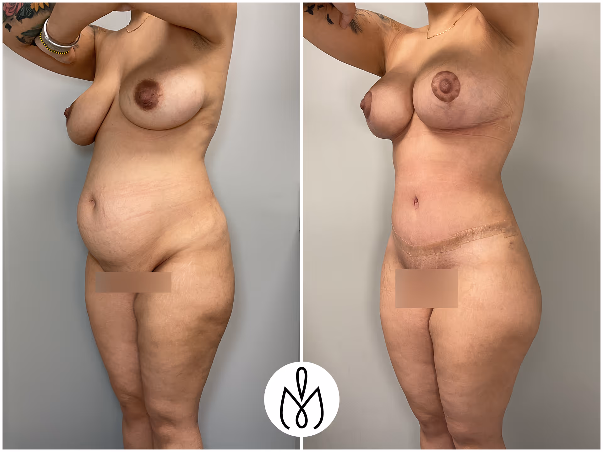 Before,After