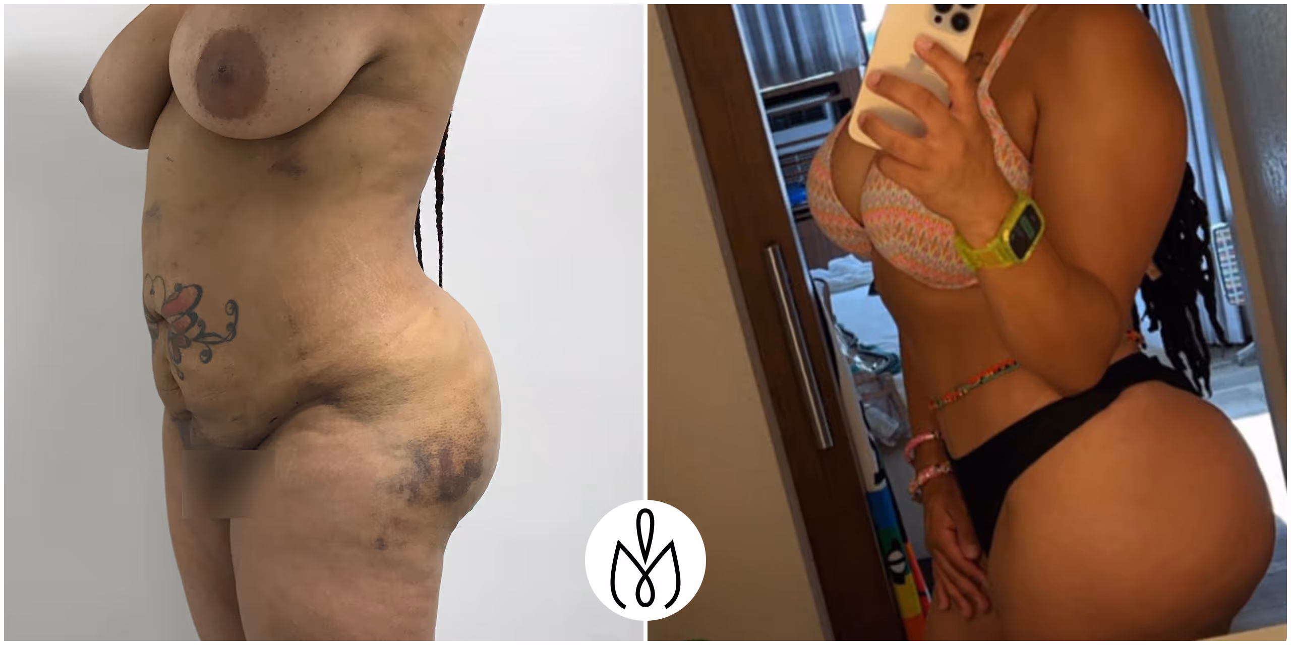 Before,After