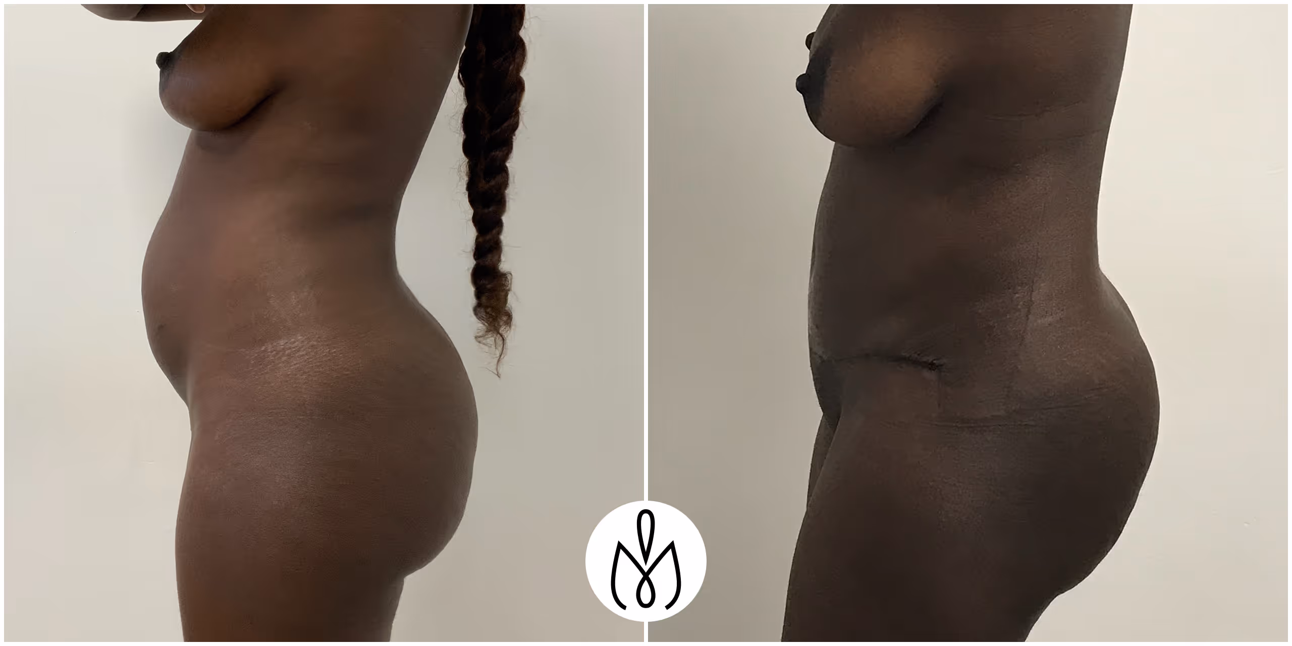 Before,After