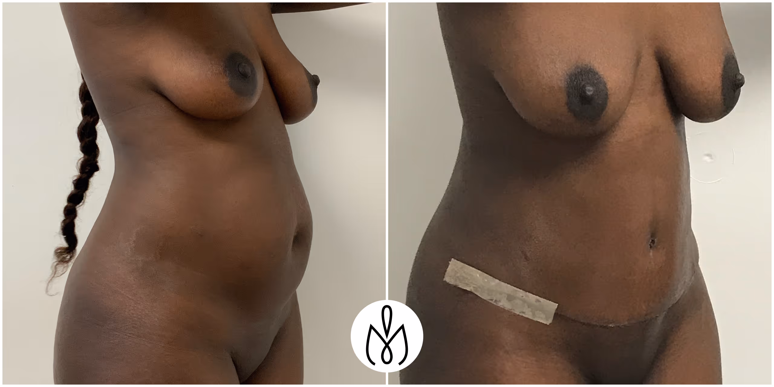 Before,After