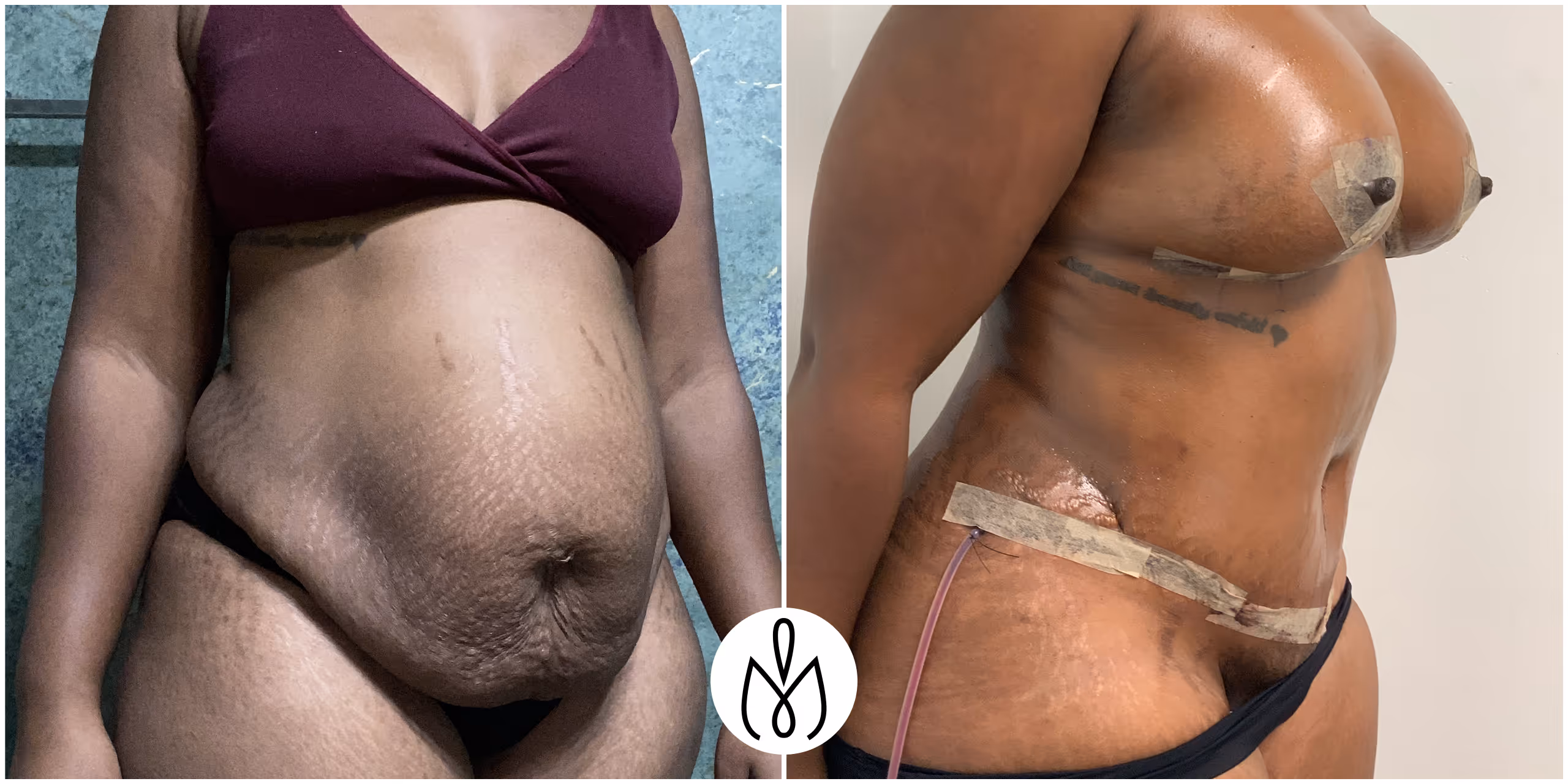 Before,After