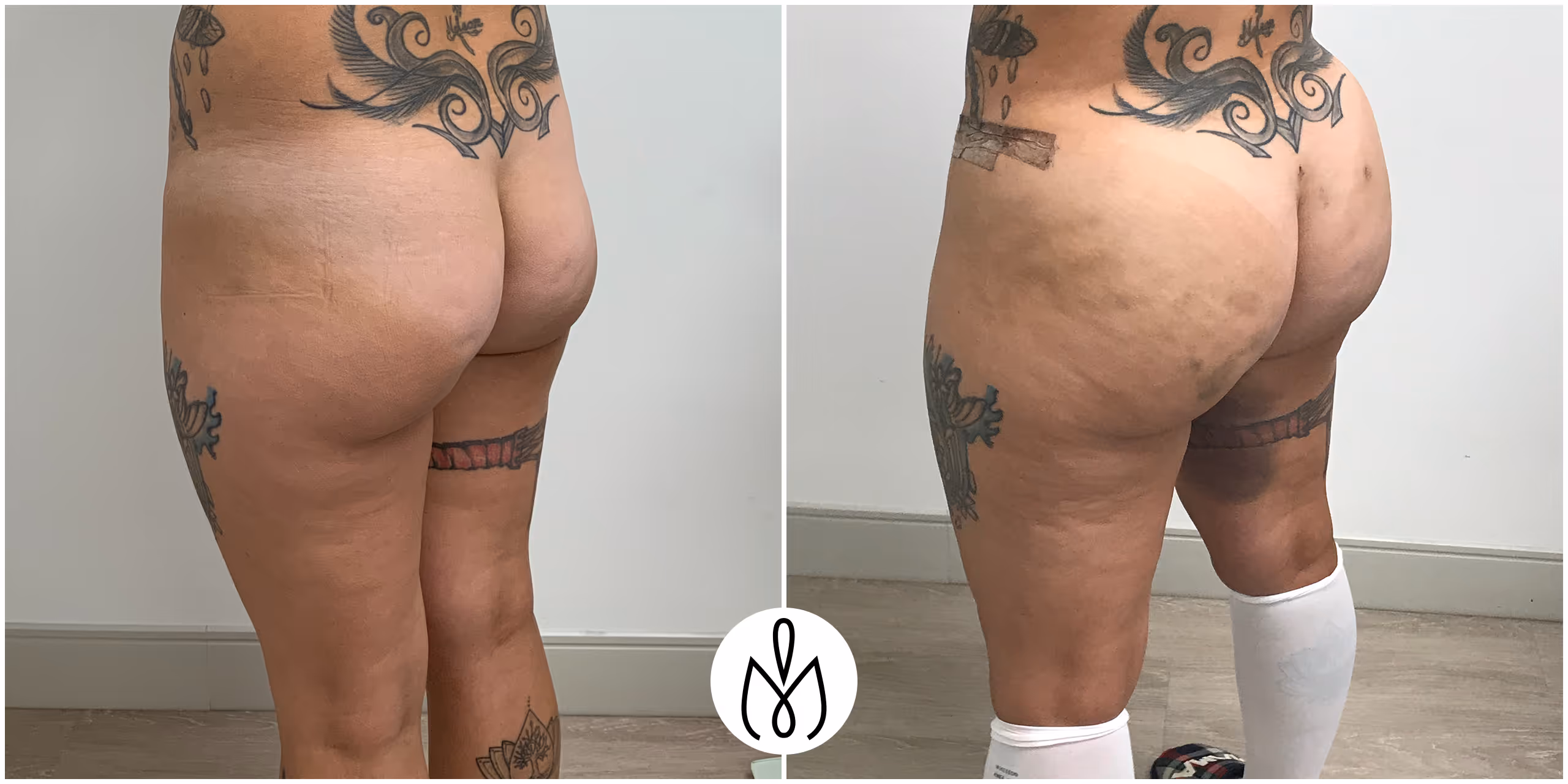 Before,After
