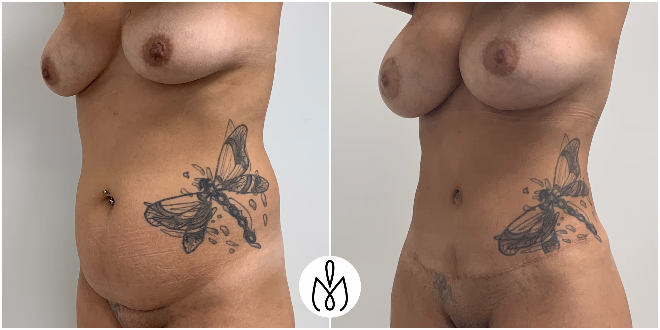 Before,After