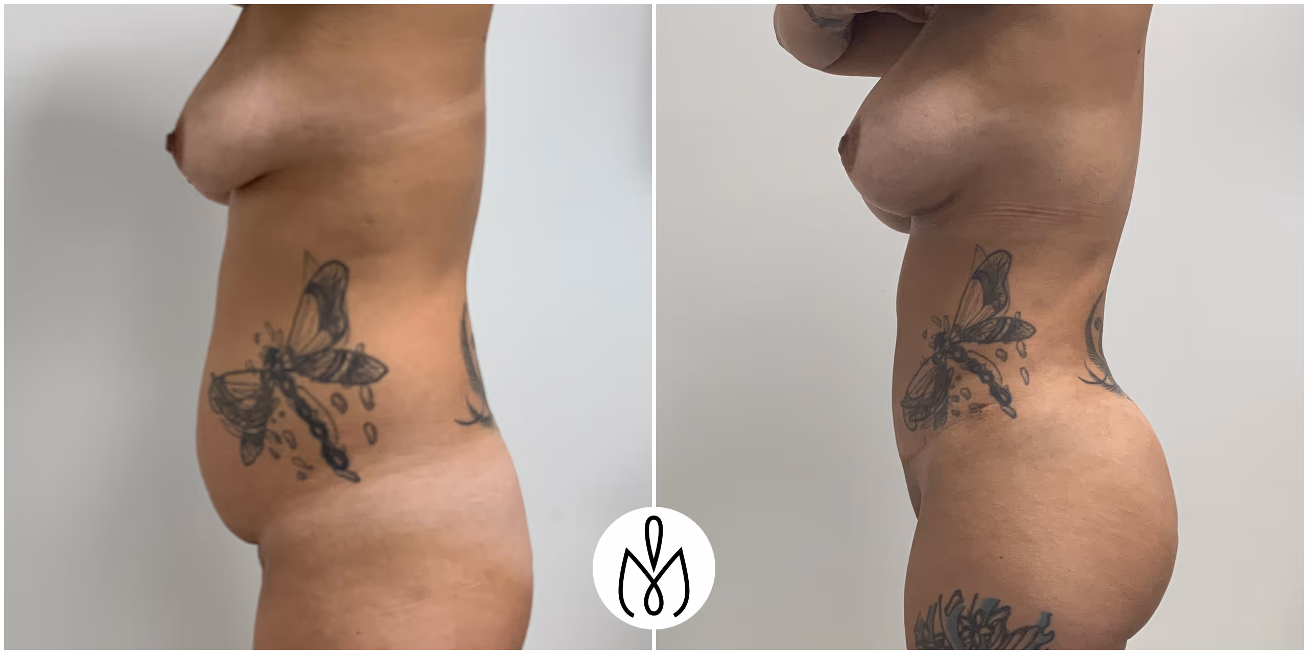 Before,After