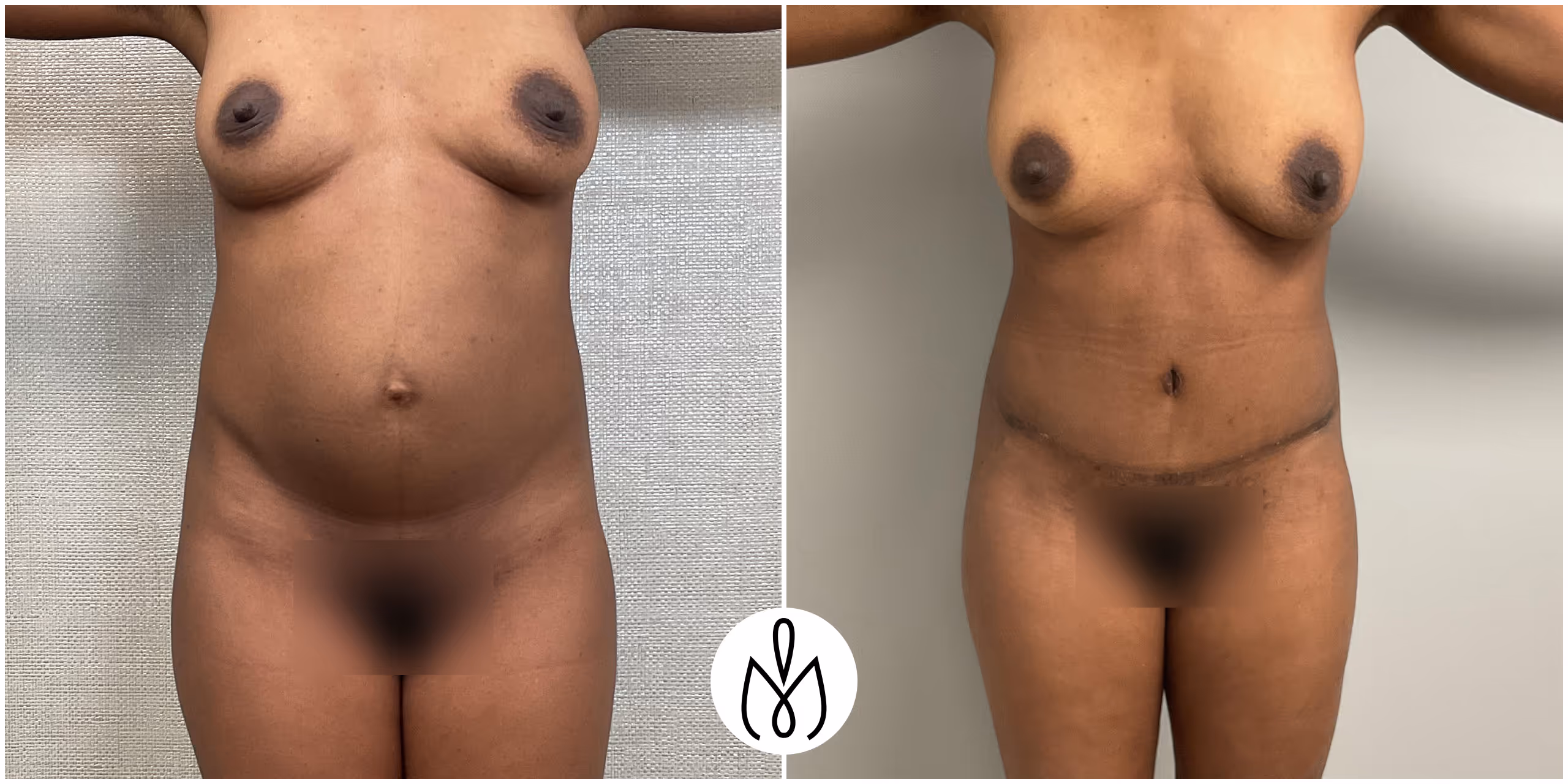 Before,After