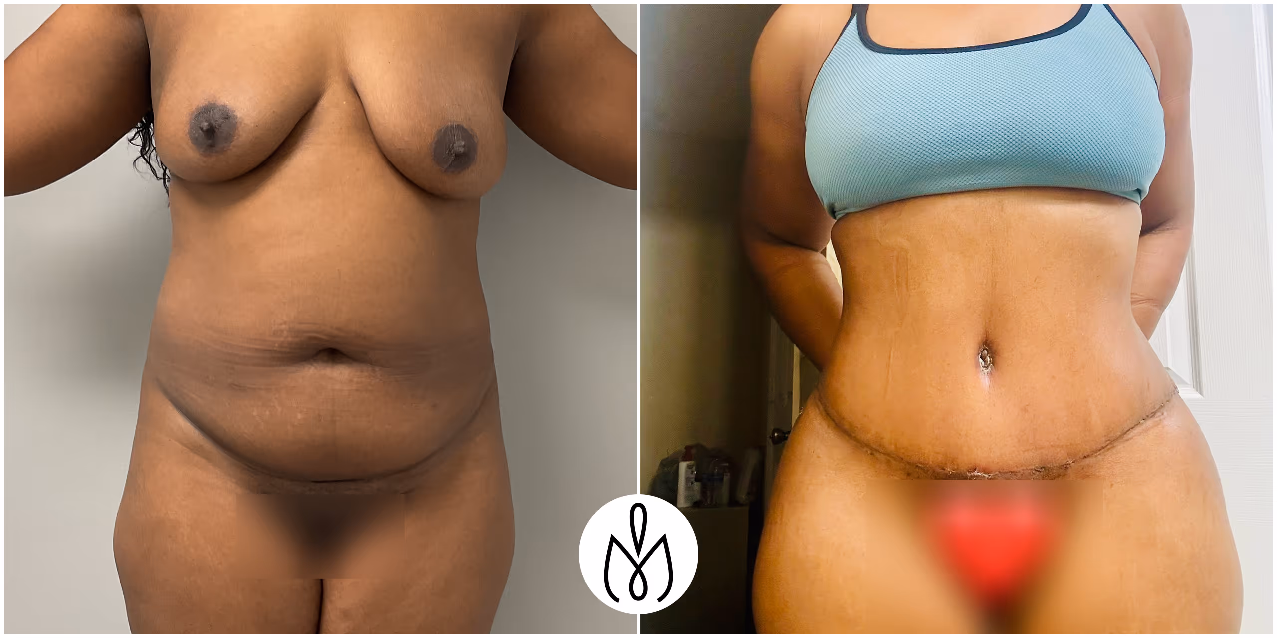 Before,After