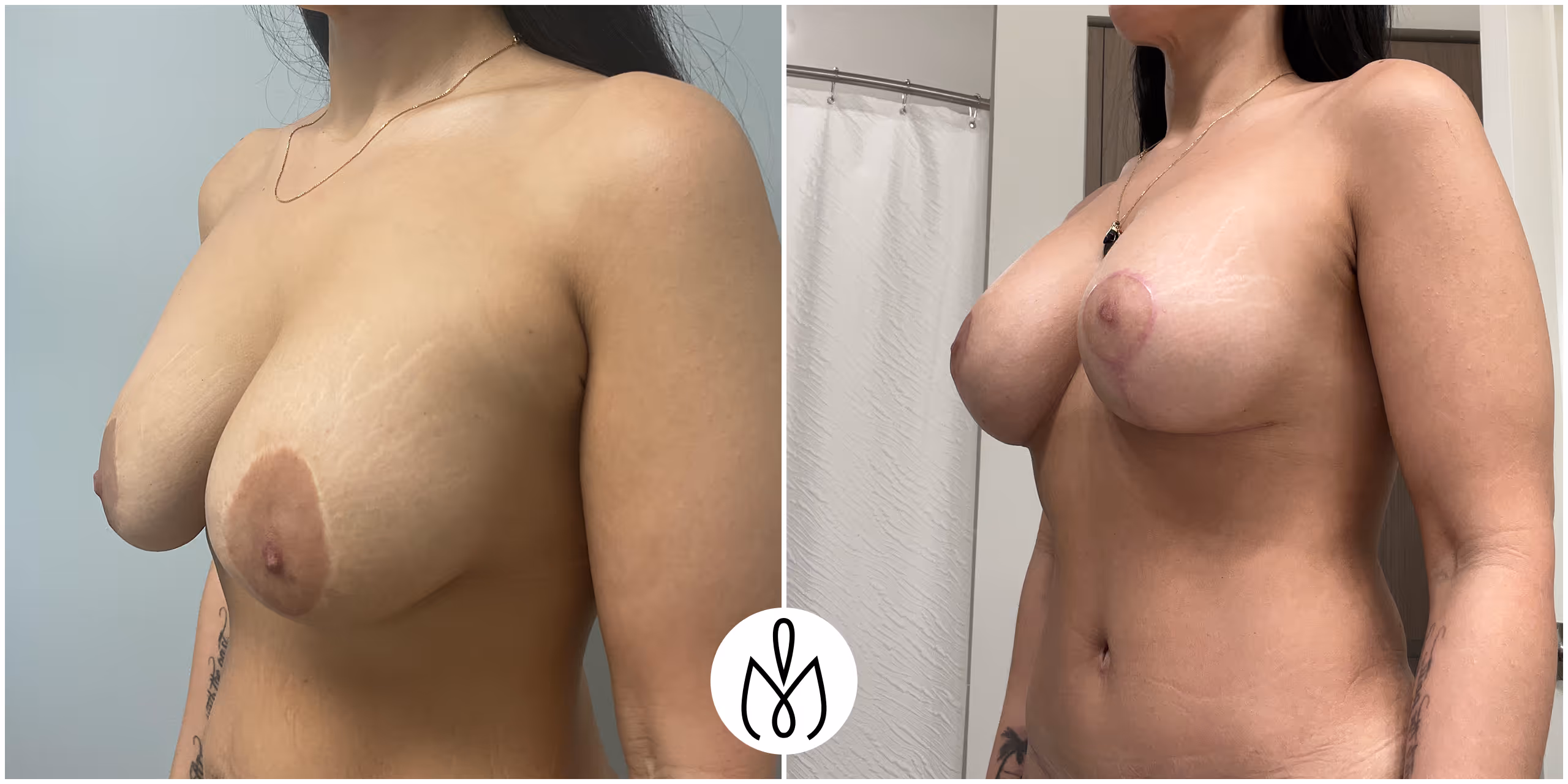 Before,After
