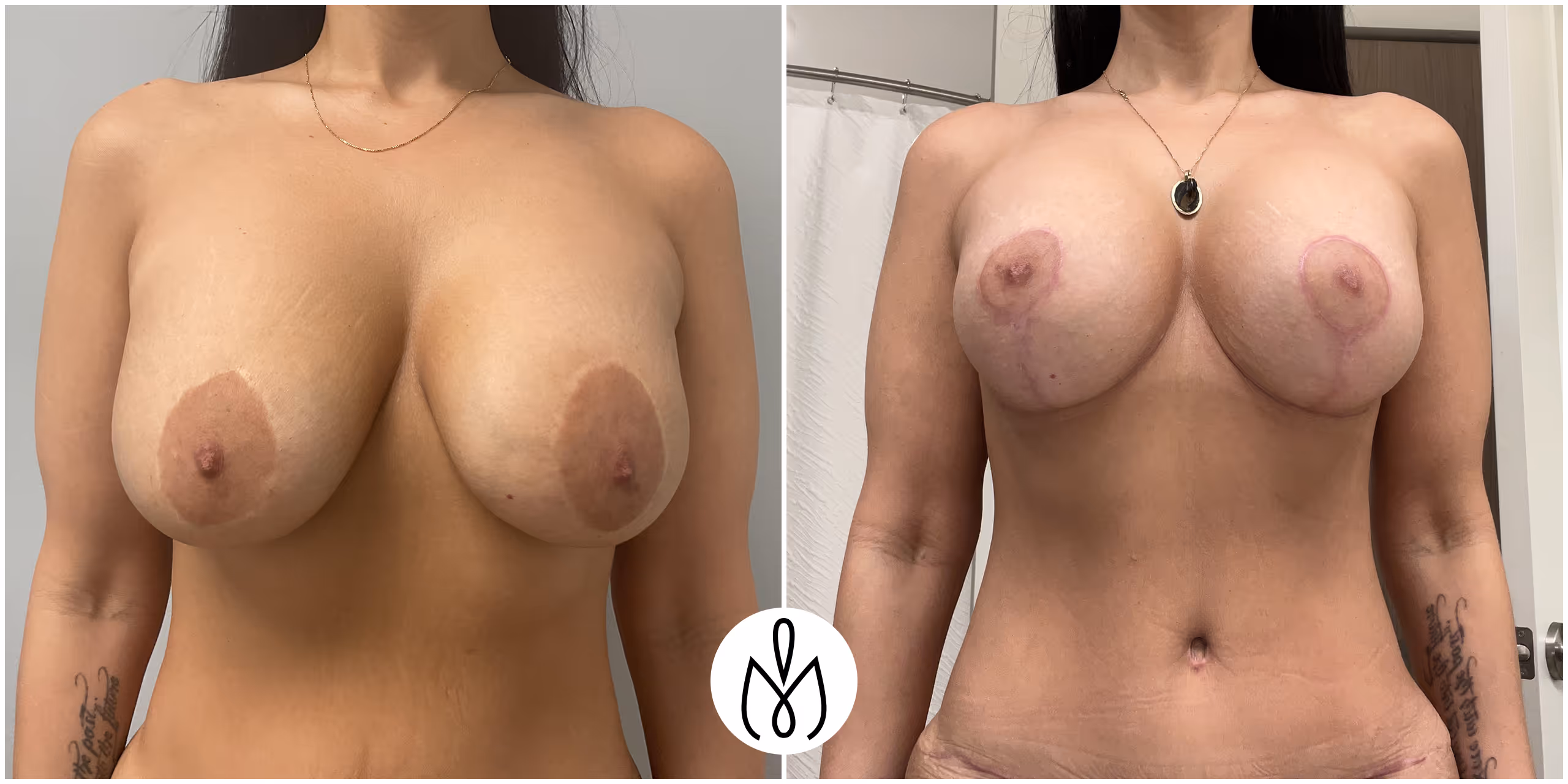 Before,After