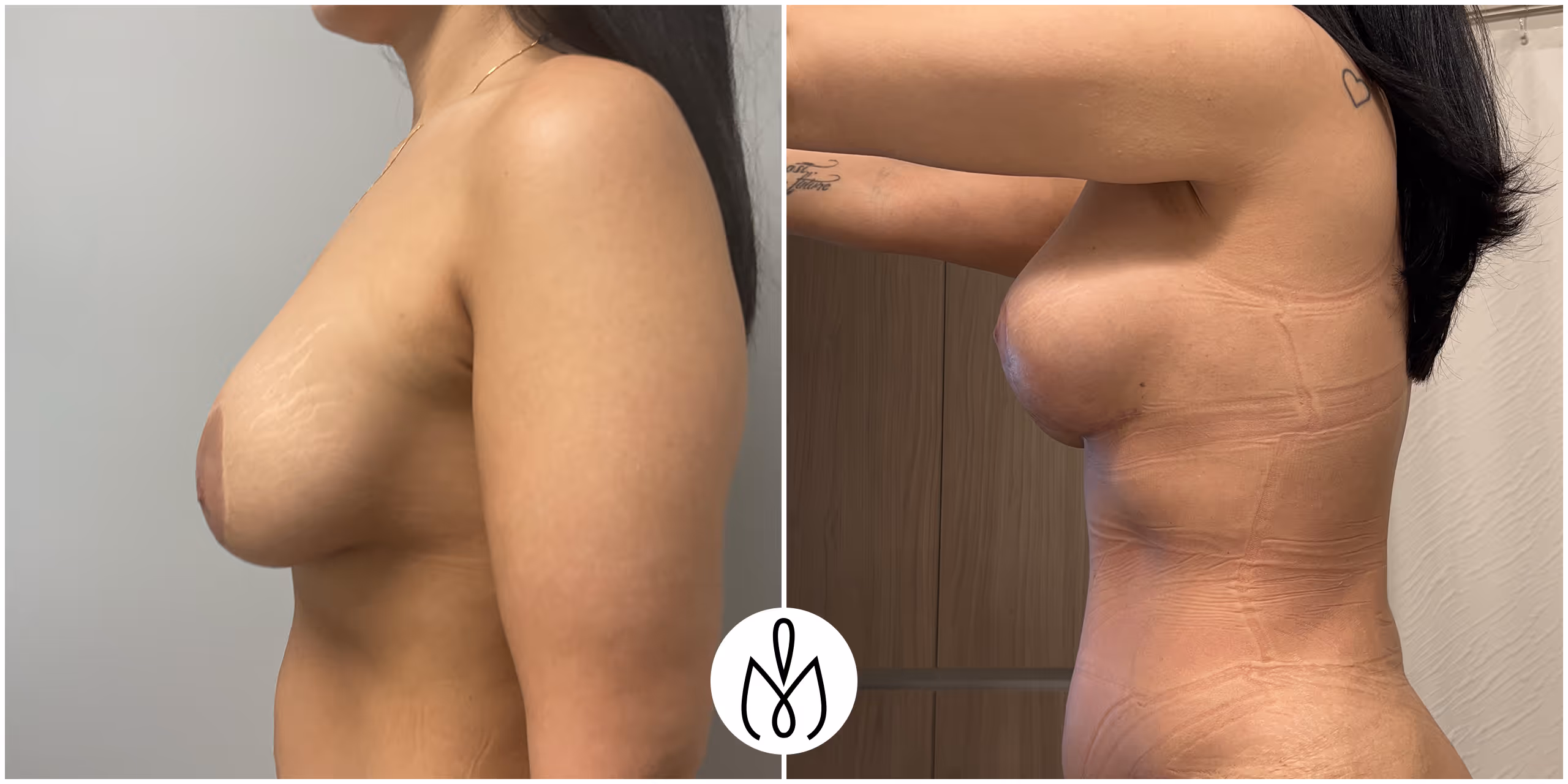 Before,After