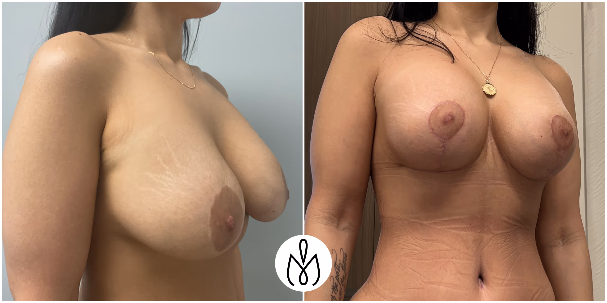 Before,After