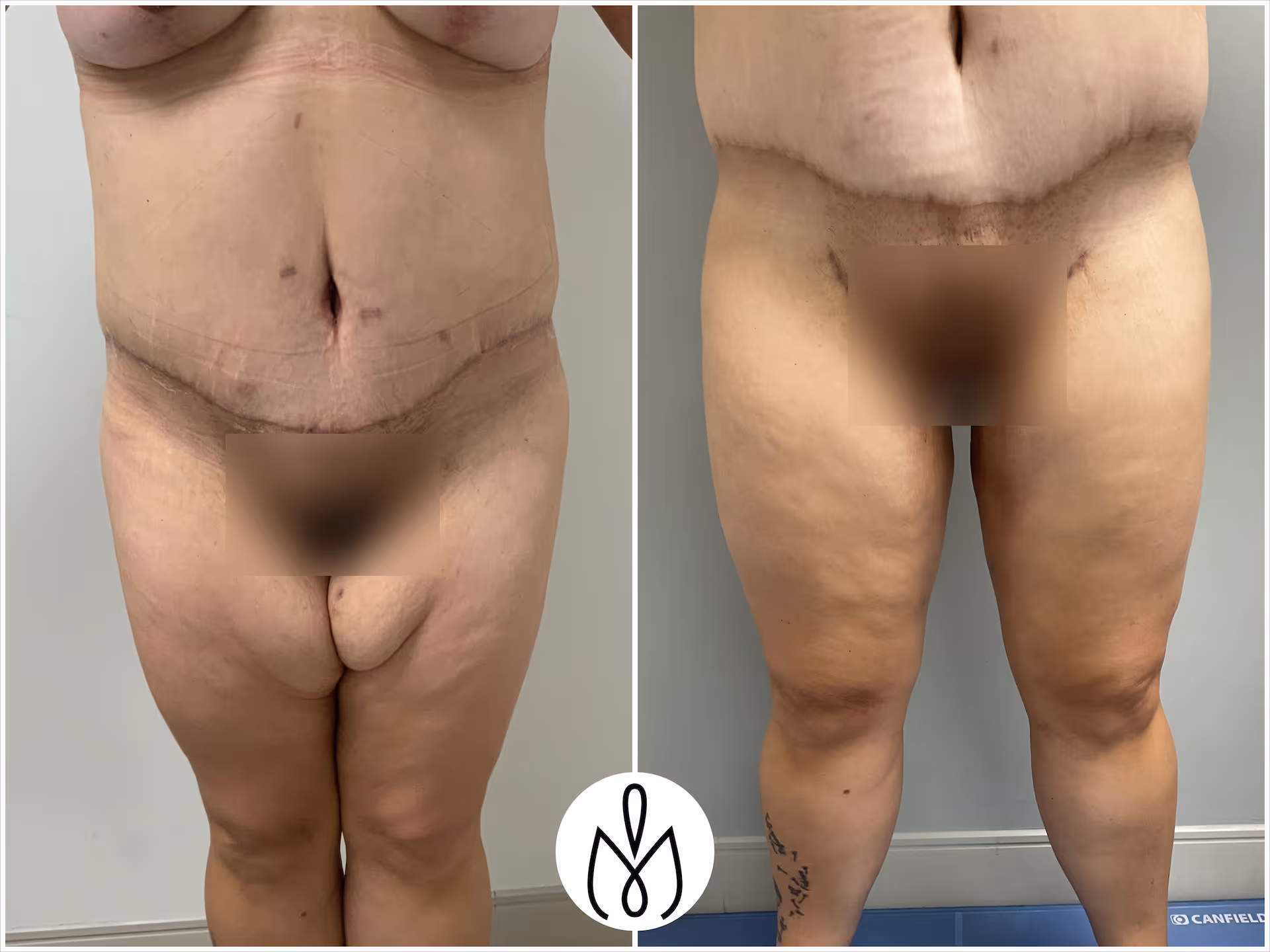 Before,After