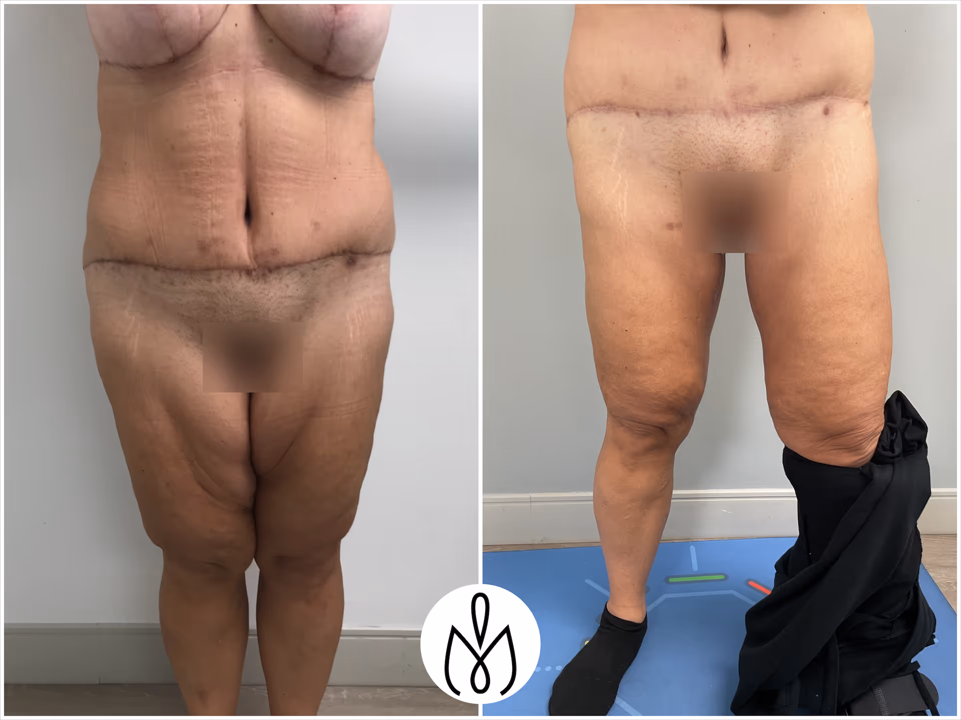 Before,After