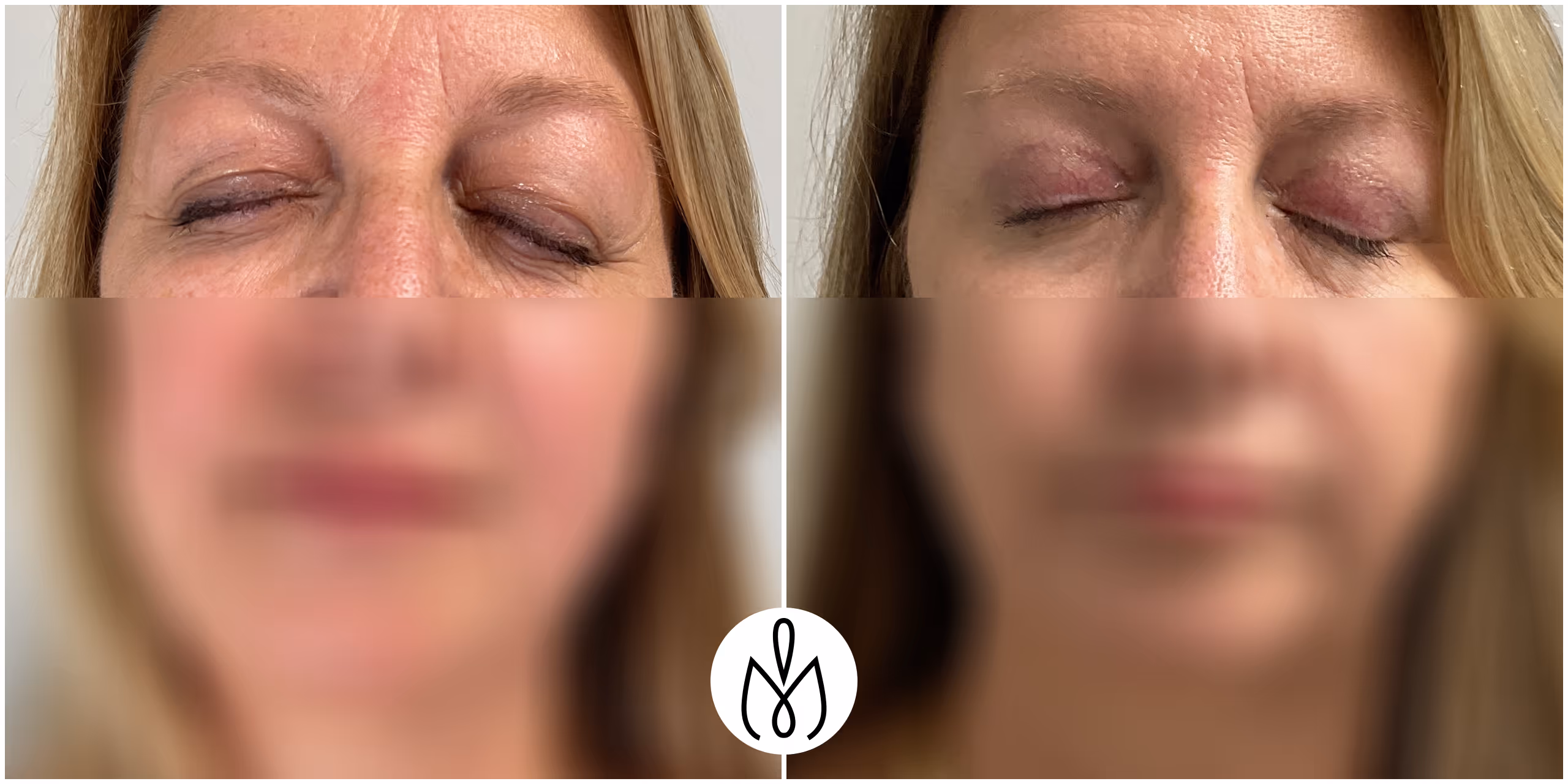 Before,After