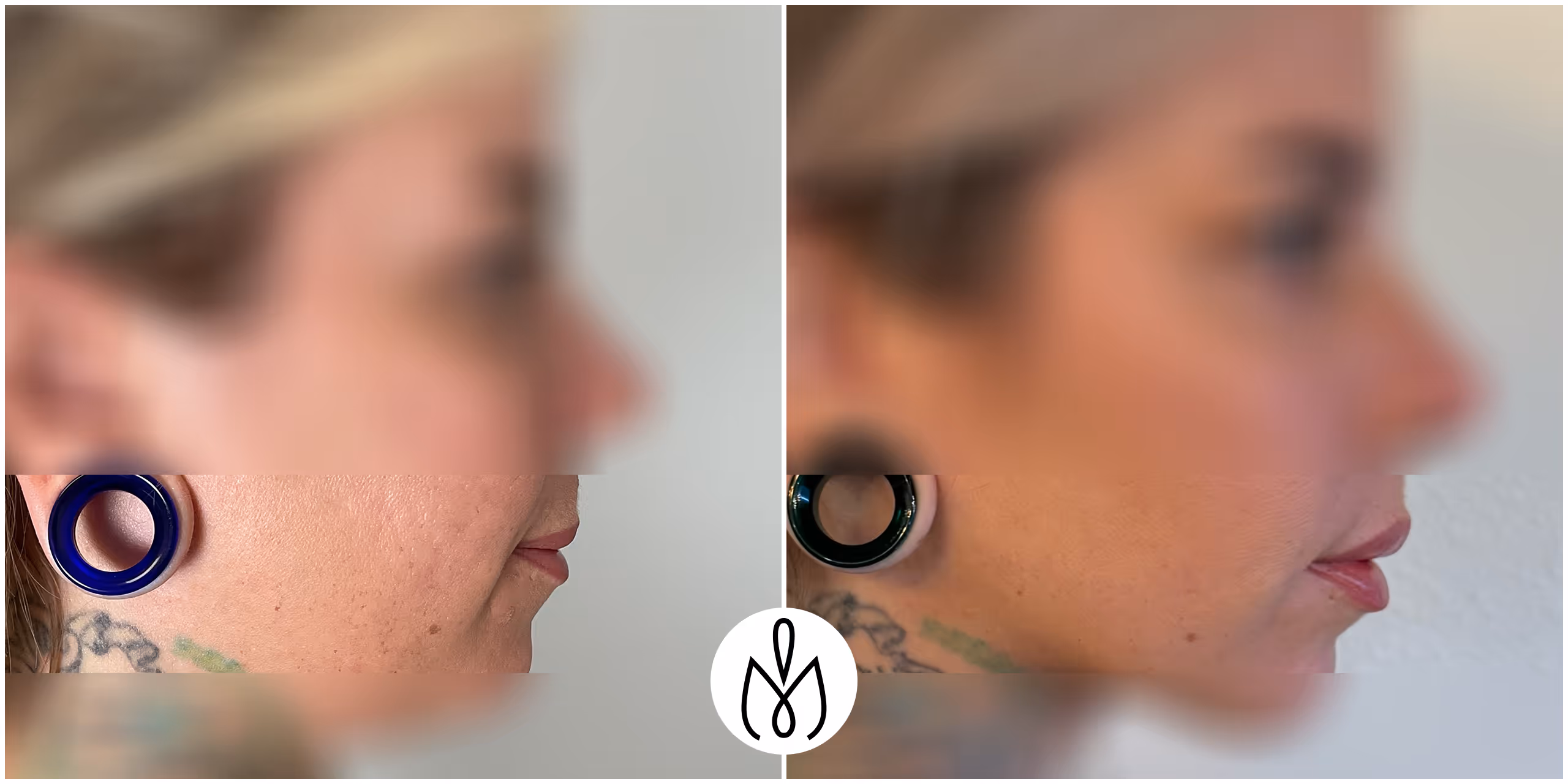 Before,After