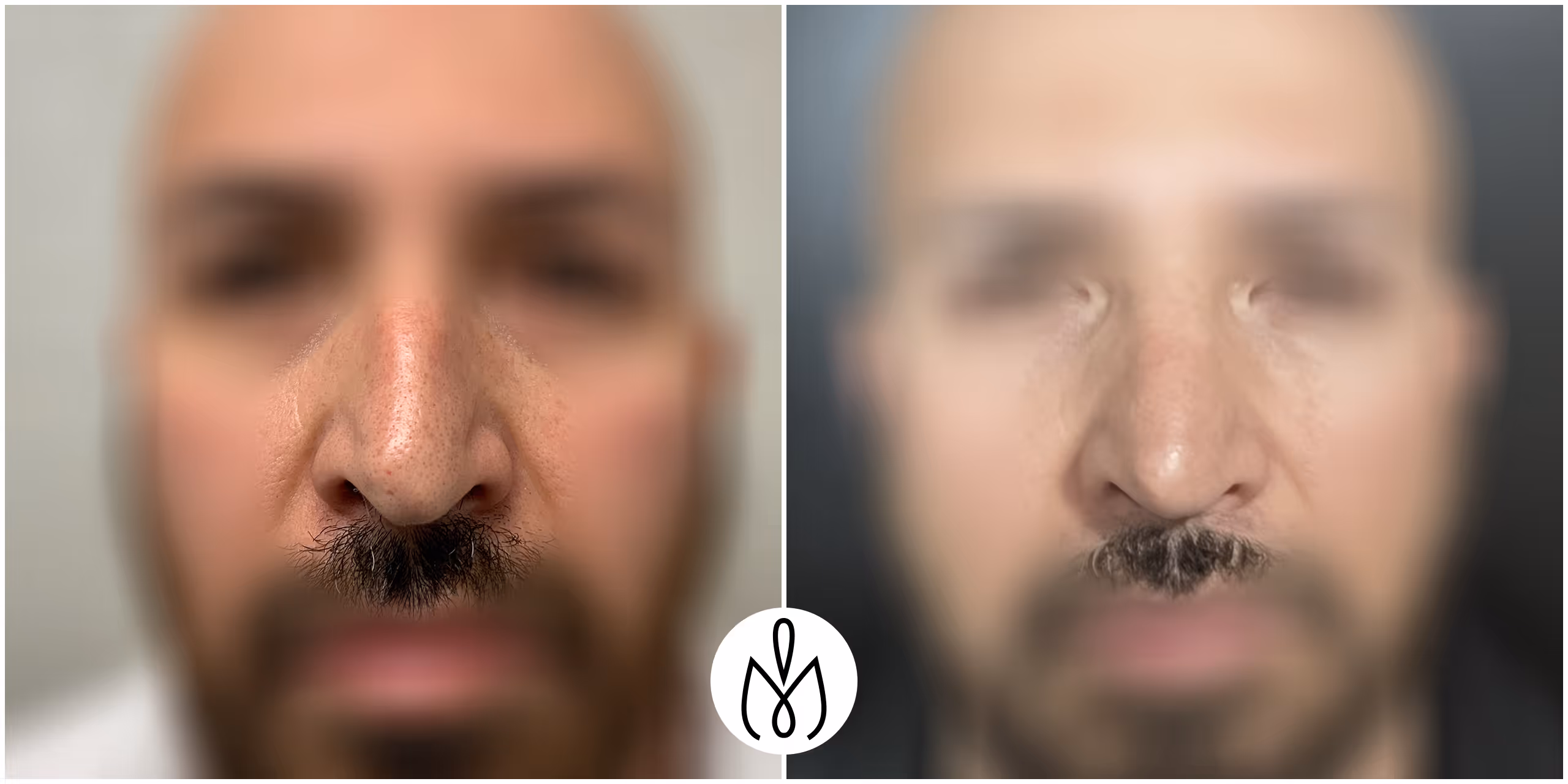 Before,After