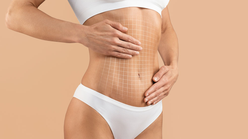 Different Types of Tummy Tucks: What Am I a Candidate For?