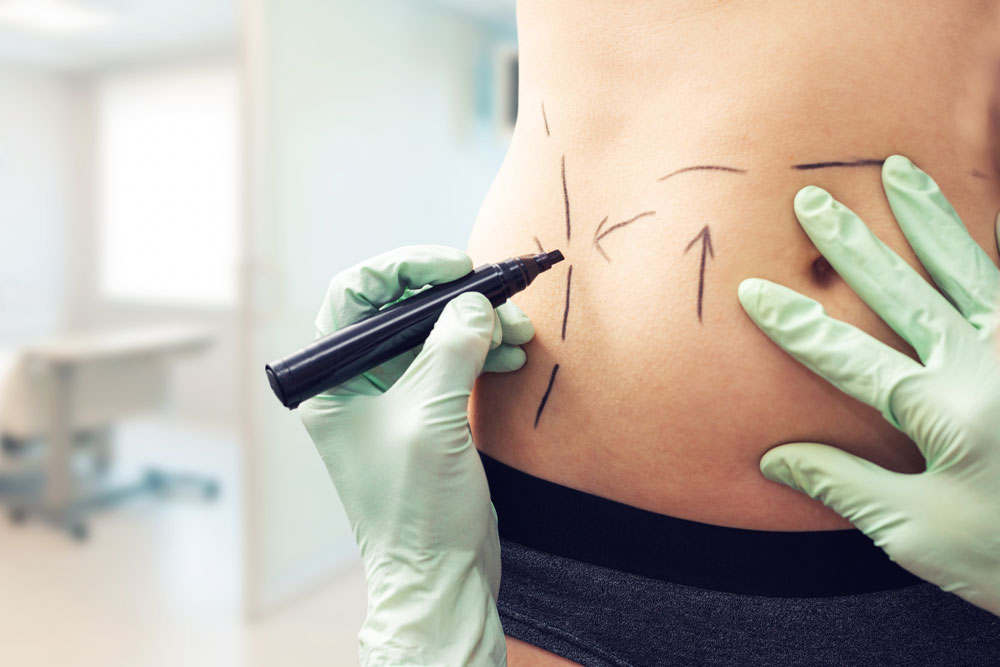 Tummy Tuck or Liposuction: Which Tackles Your Specific Concerns?
