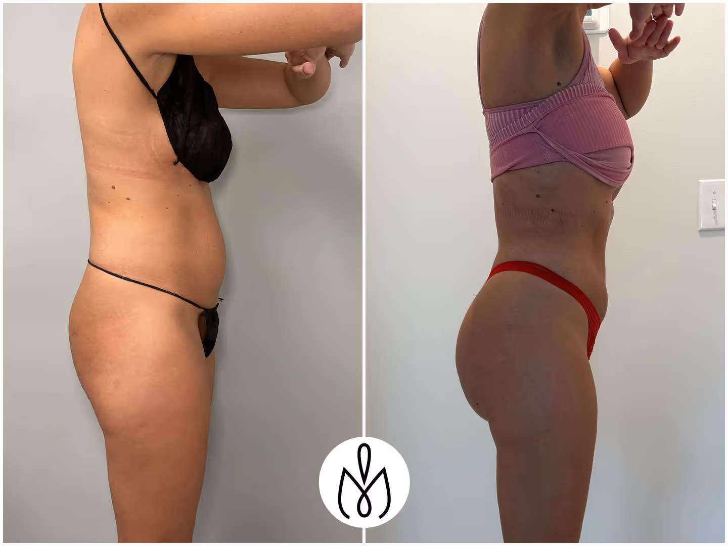 Before,After