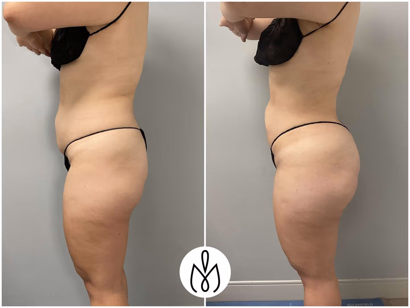 Before,After
