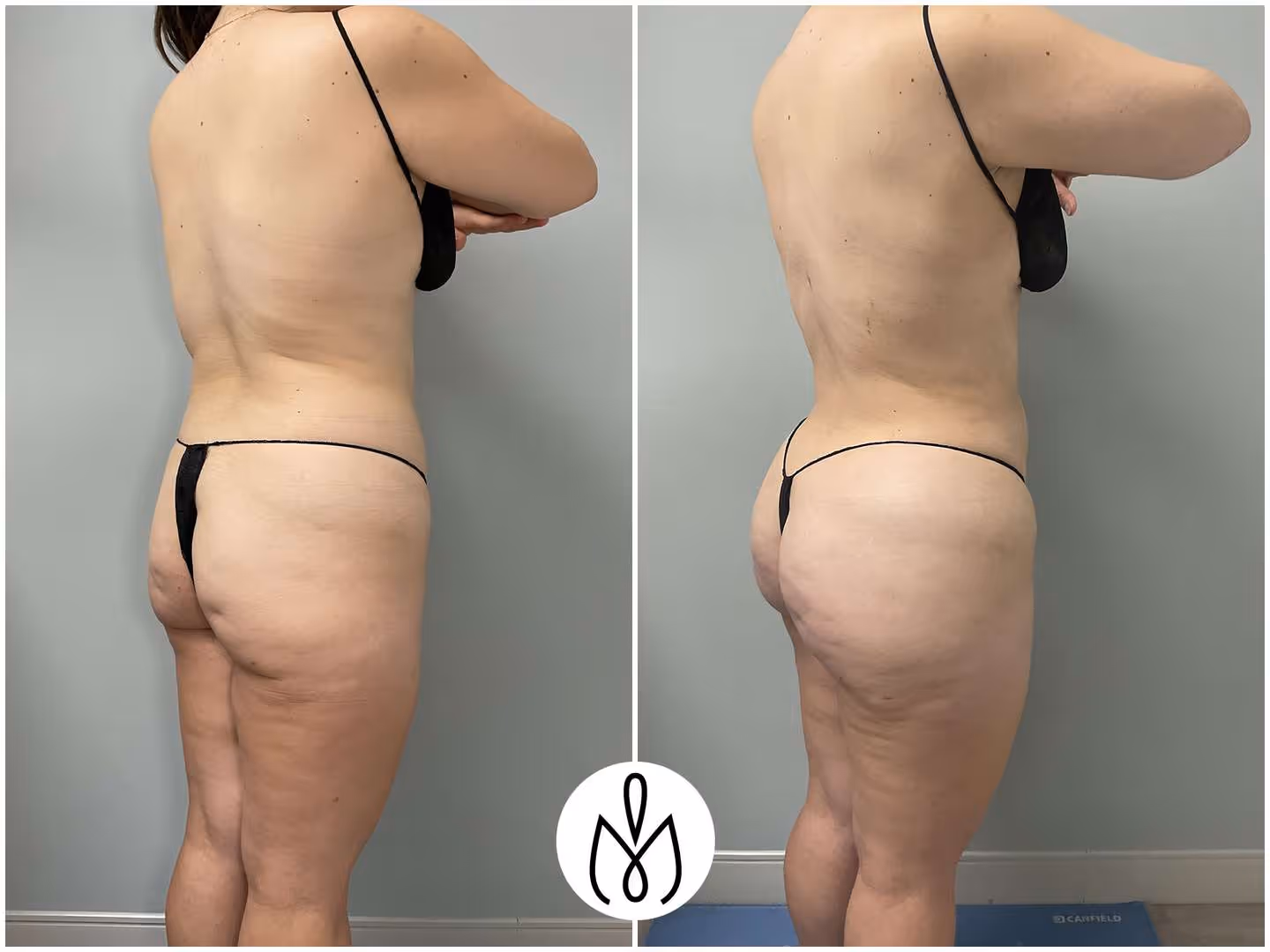 Before,After