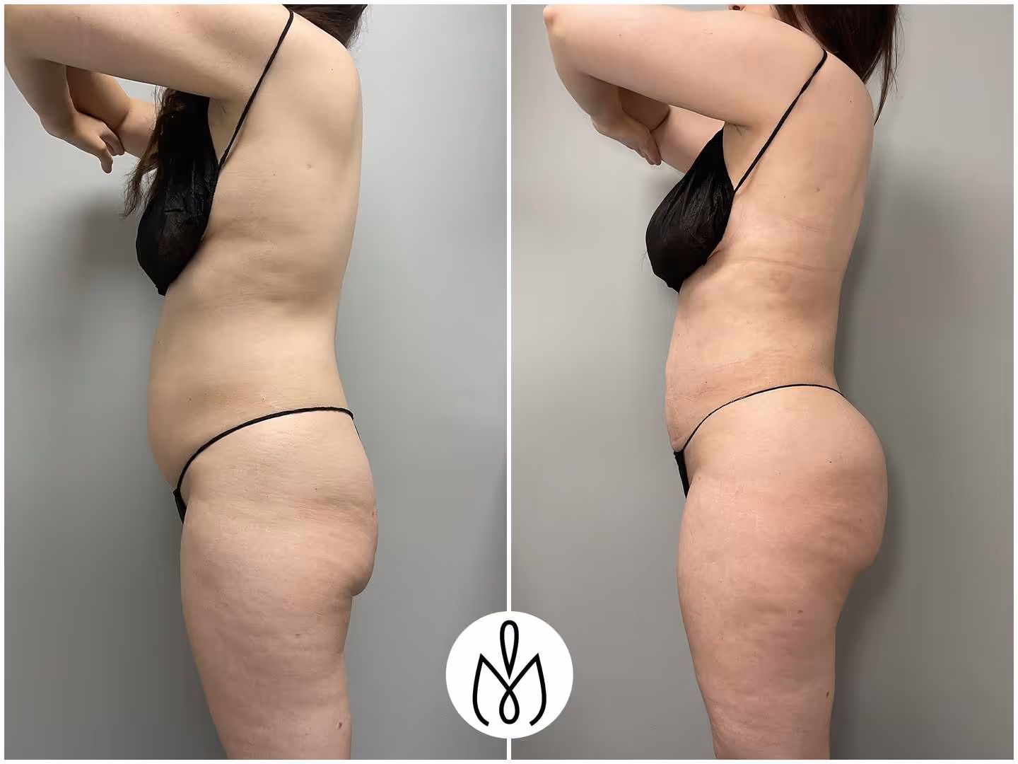 Before,After