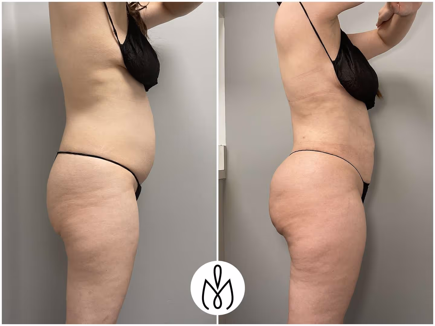 Before,After
