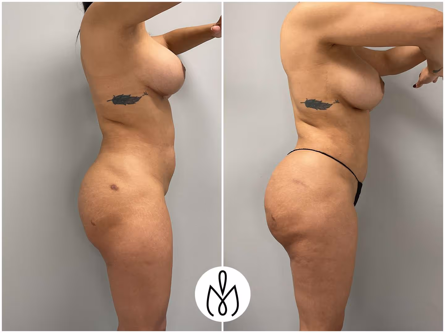 Before,After