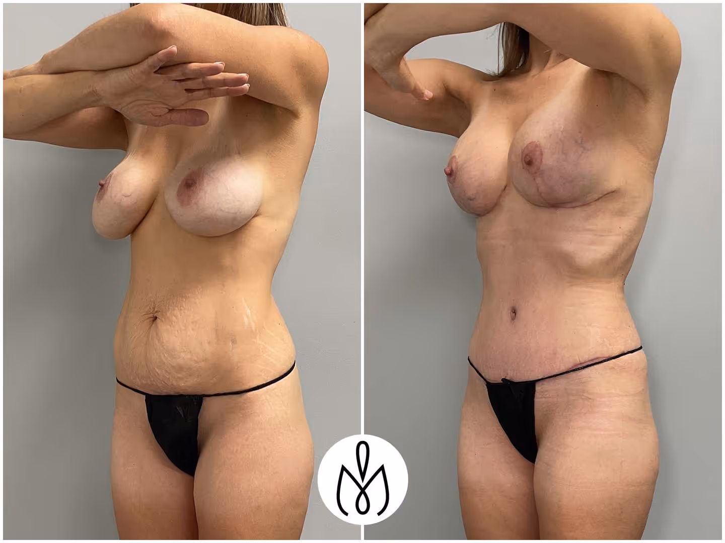Before,After