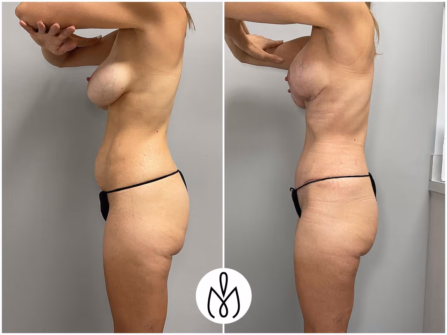 Before,After