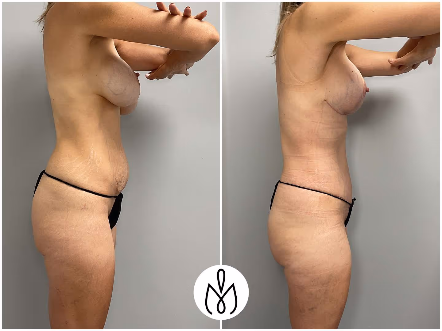 Before,After