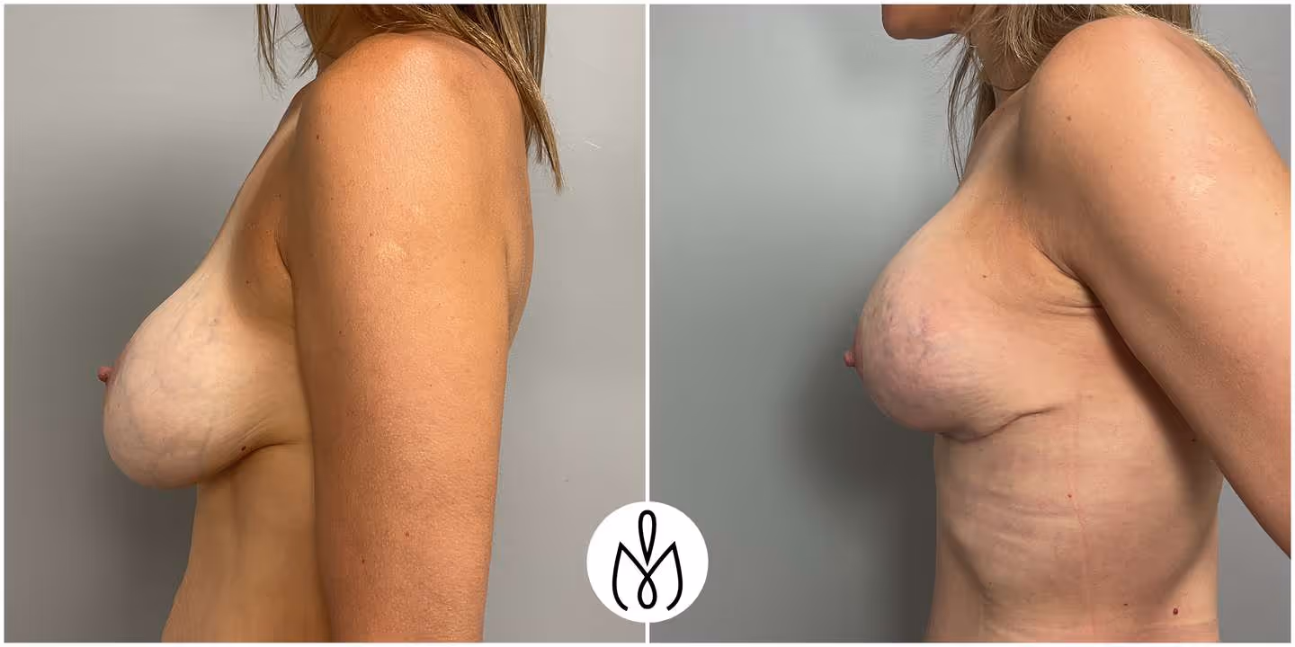 Before,After